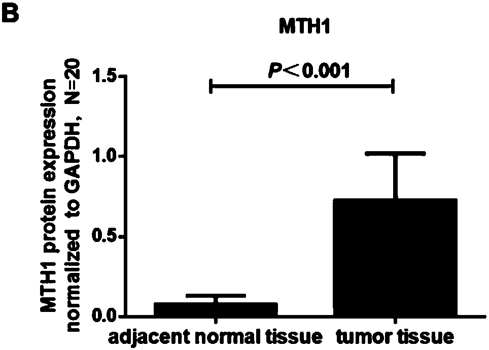 Marker for determining prognosis of colorectal cancer and application thereof