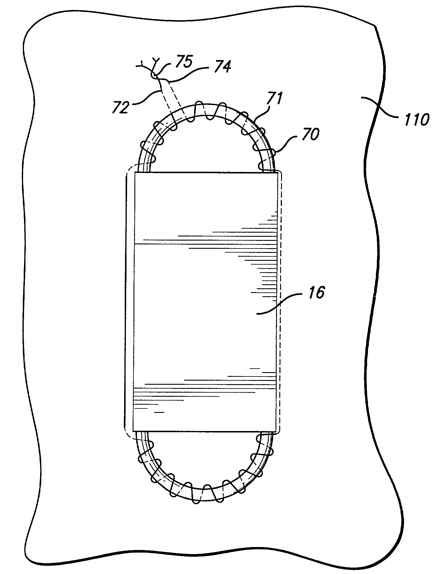 Endovascular graft with sensors design and attachment methods