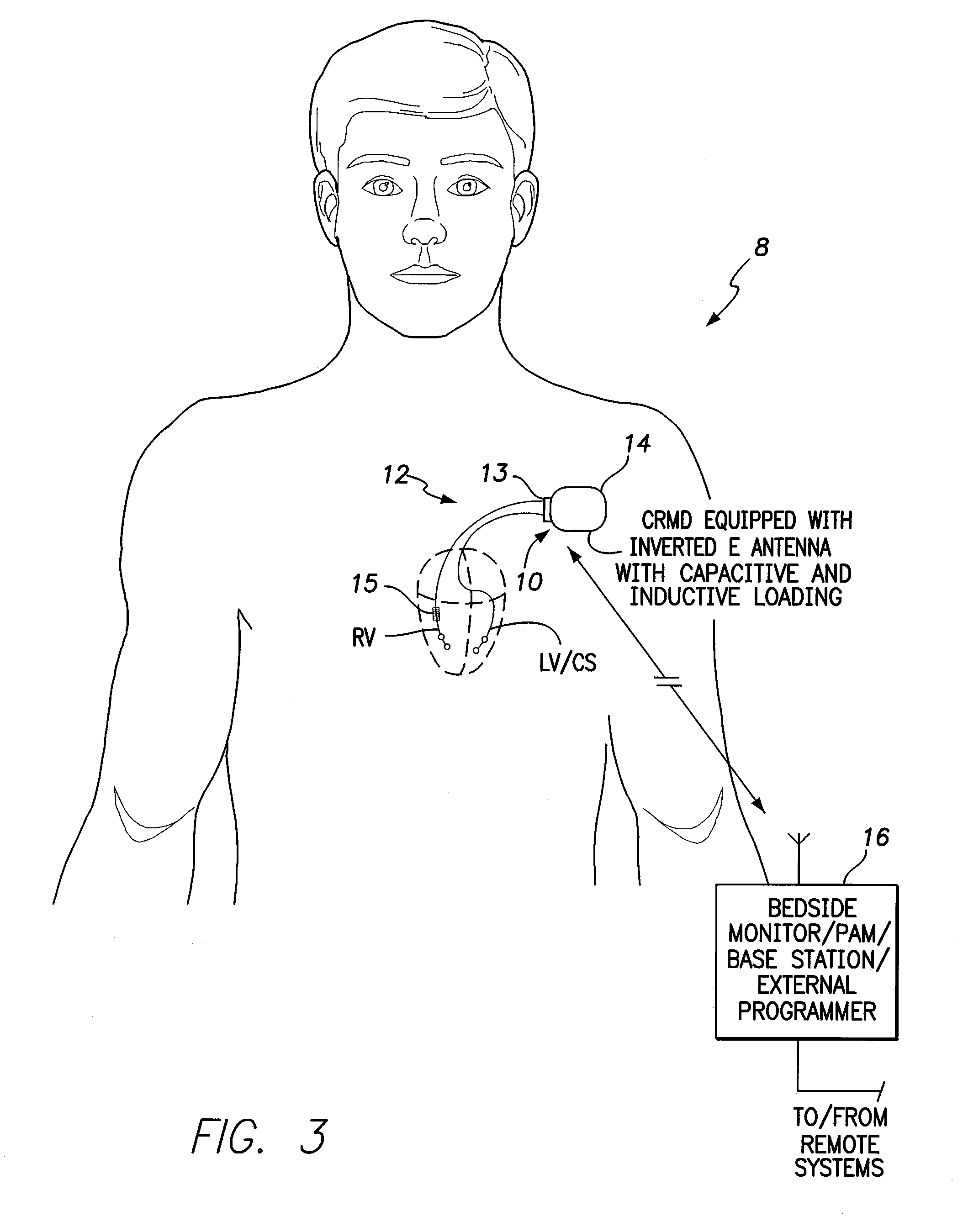 Inverted e antenna with parallel plate capacitor formed along an arm of the antenna for use with an implantable medical device