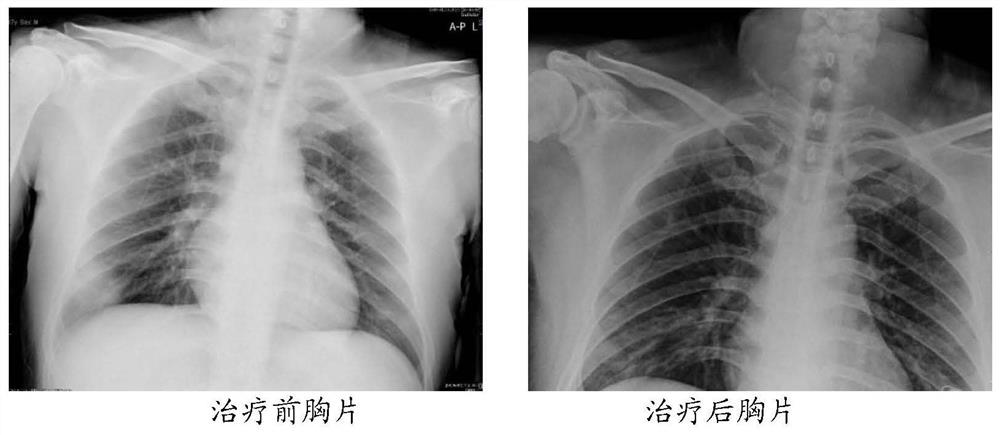 Traditional Chinese medicine compound preparation for treating novel coronavirus infection