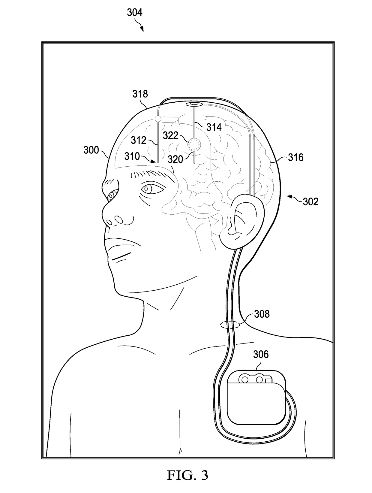 Visualization System for Deep Brain Stimulation