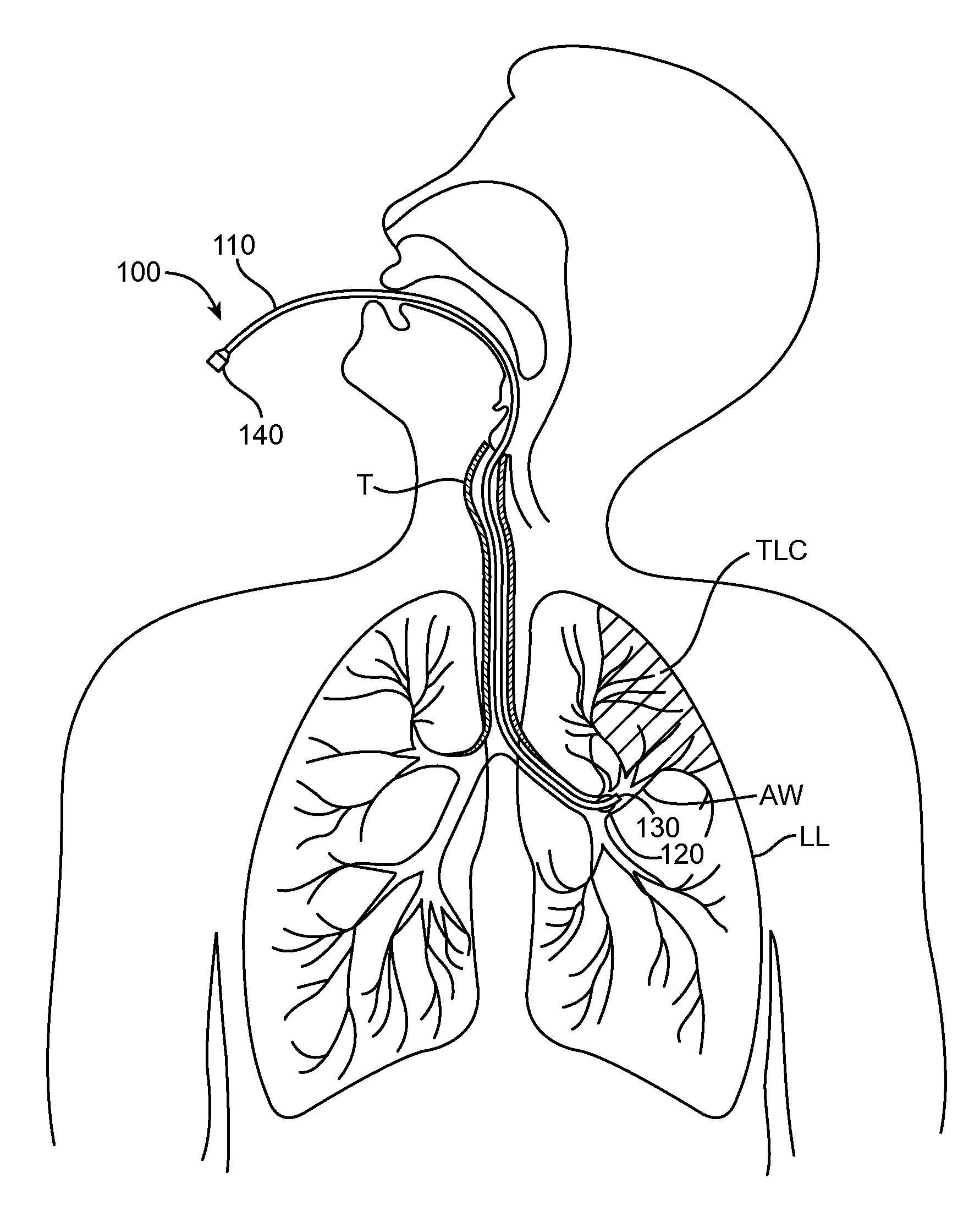 Methods and systems for endobronchial diagnostics