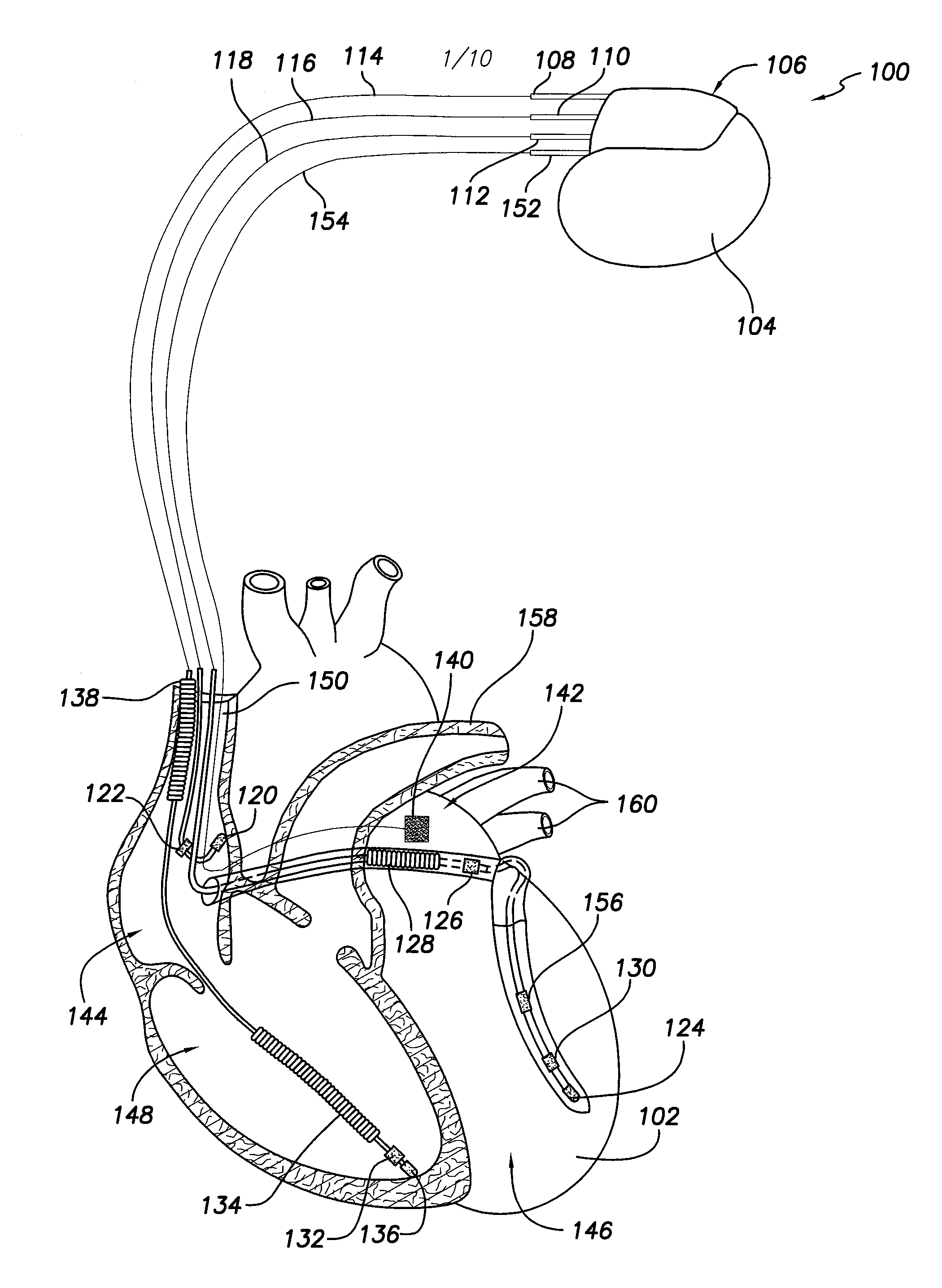 Systems and Methods for Adjusting a Pacing Rate Based on Cardiac Pressure