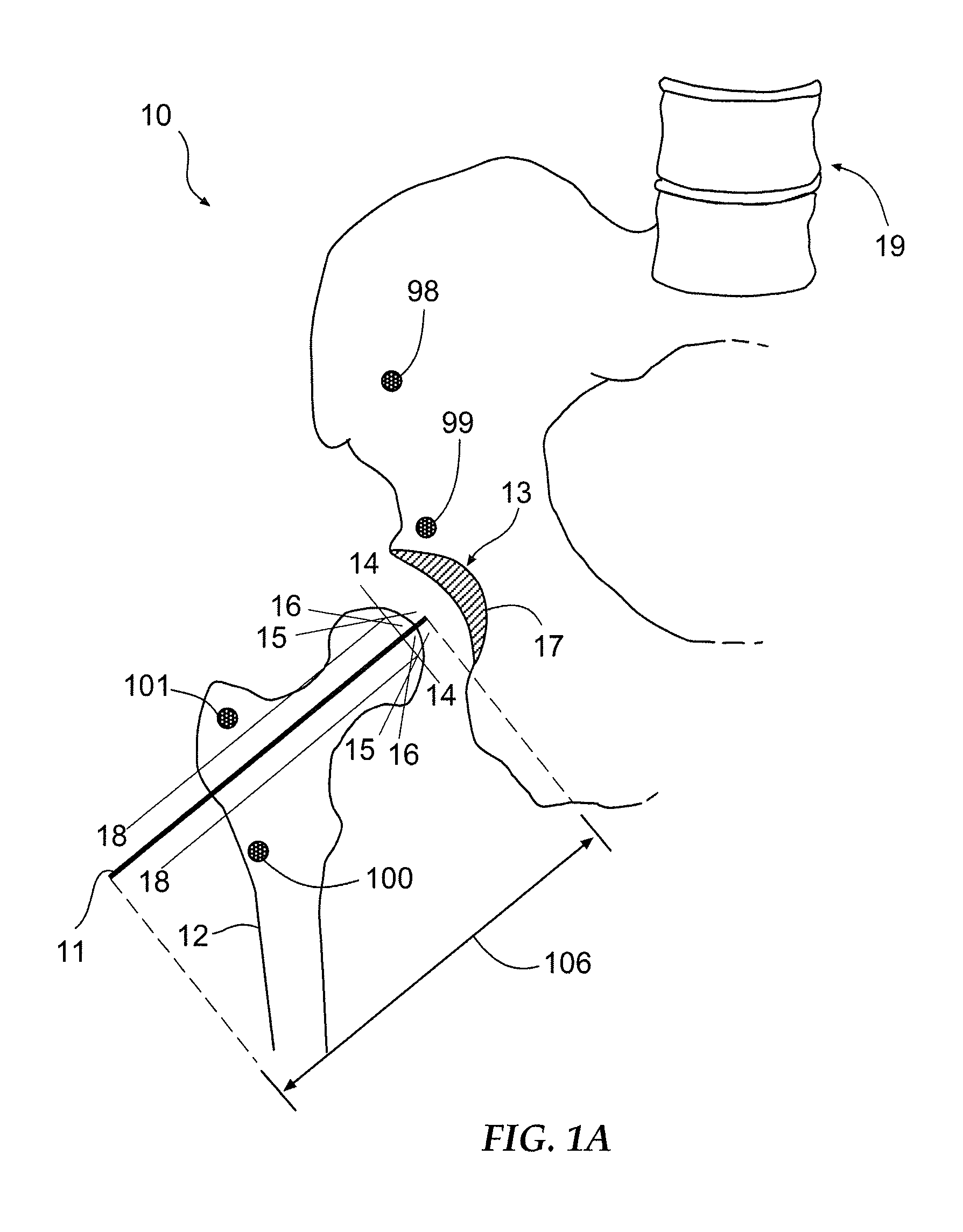 Apparatus for arthroscopic assisted arthroplasty of the hip joint