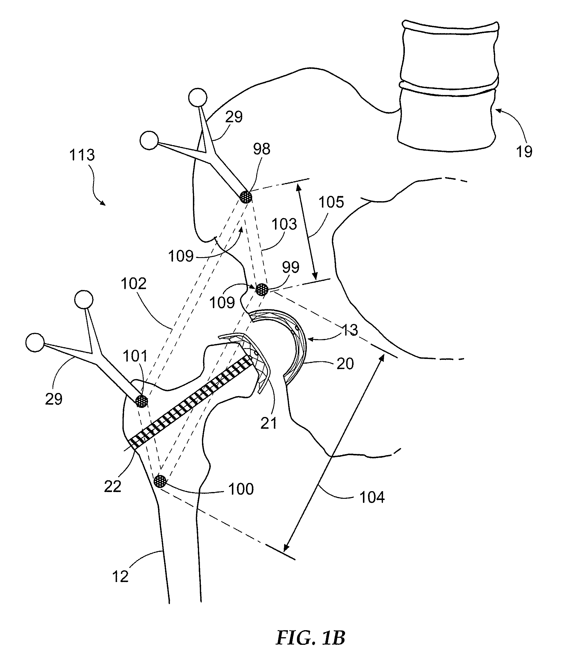 Apparatus for arthroscopic assisted arthroplasty of the hip joint