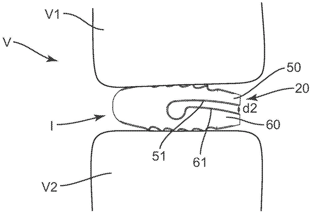 Adaptable interbody implant and methods of use