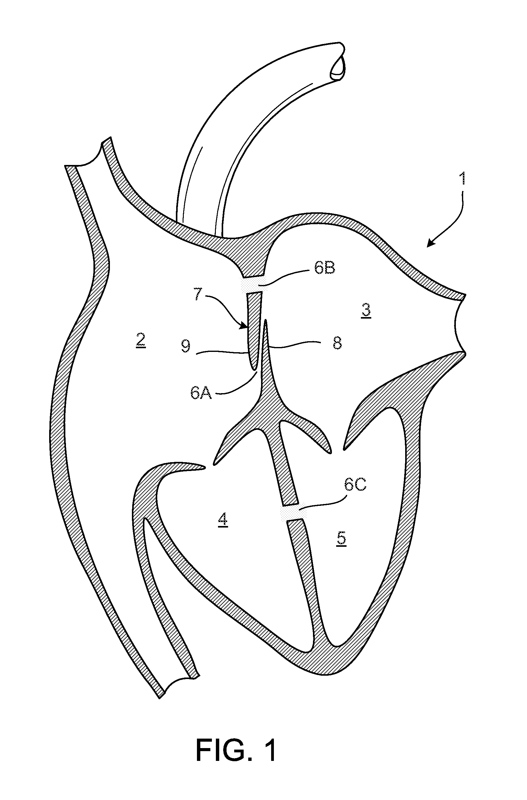 Heart Occlusion Devices