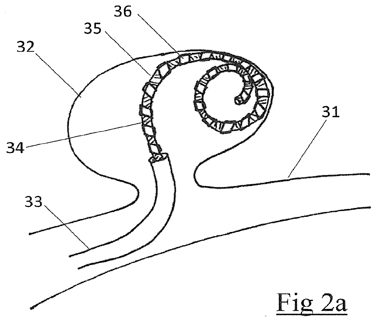 DEVICE AND METHOD FOR ENDOVASCULAR TREATMENT OF ANEURYSMS USING EMBOLIC ePTFE