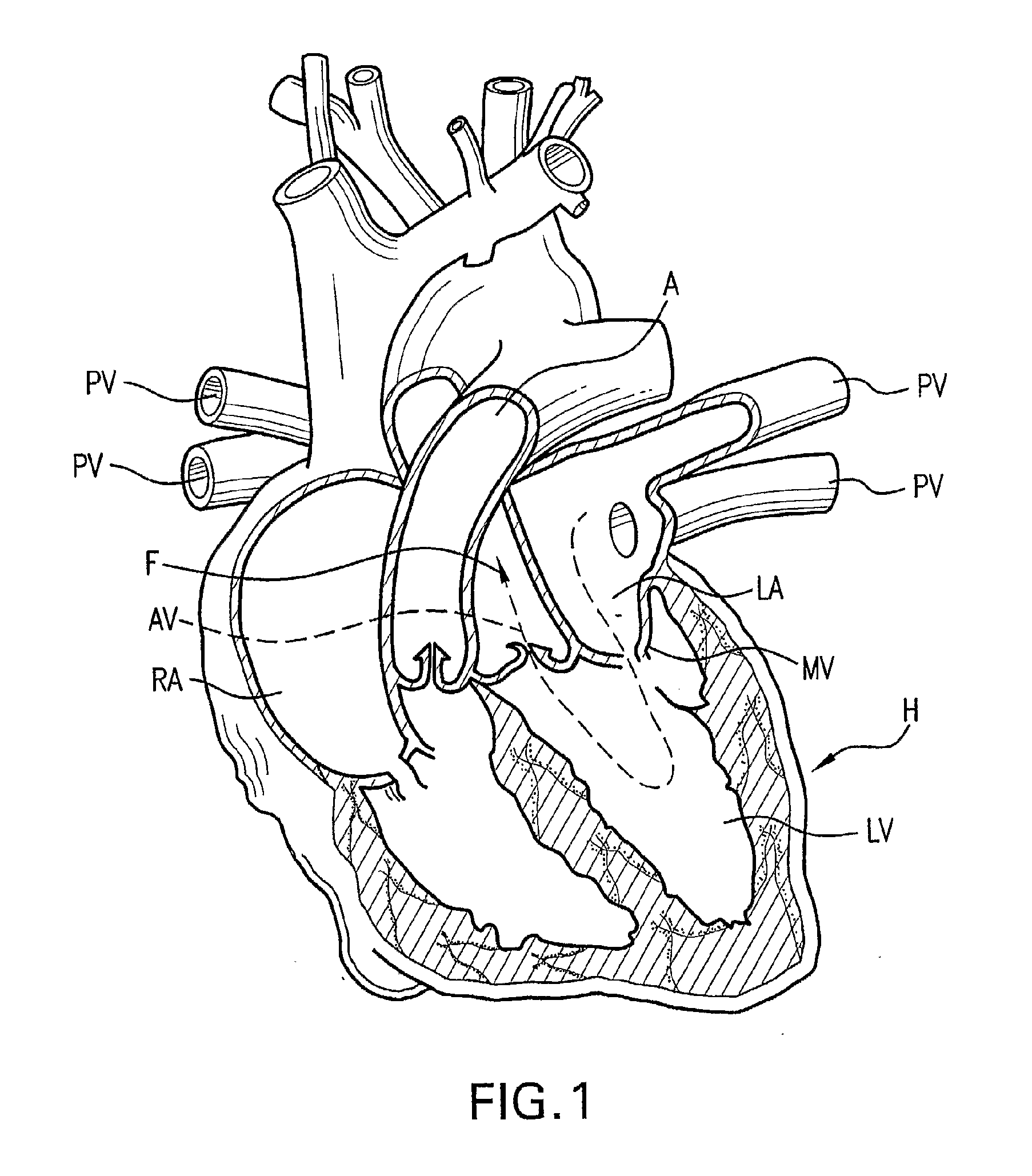 System And Method For Assisted Partitioning Of Body Conduits
