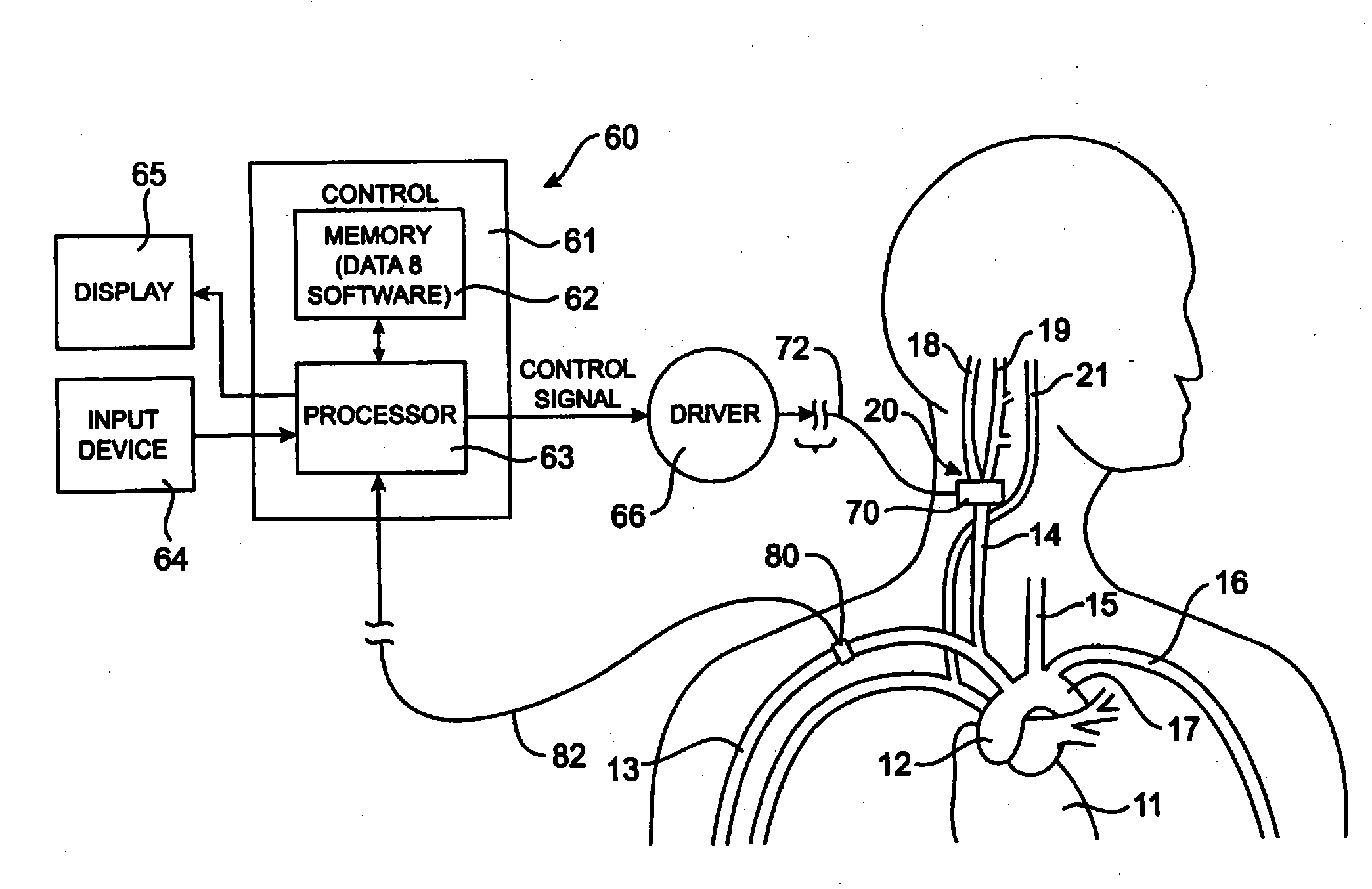 Devices and methods for cardiovascular reflex control via coupled electrodes