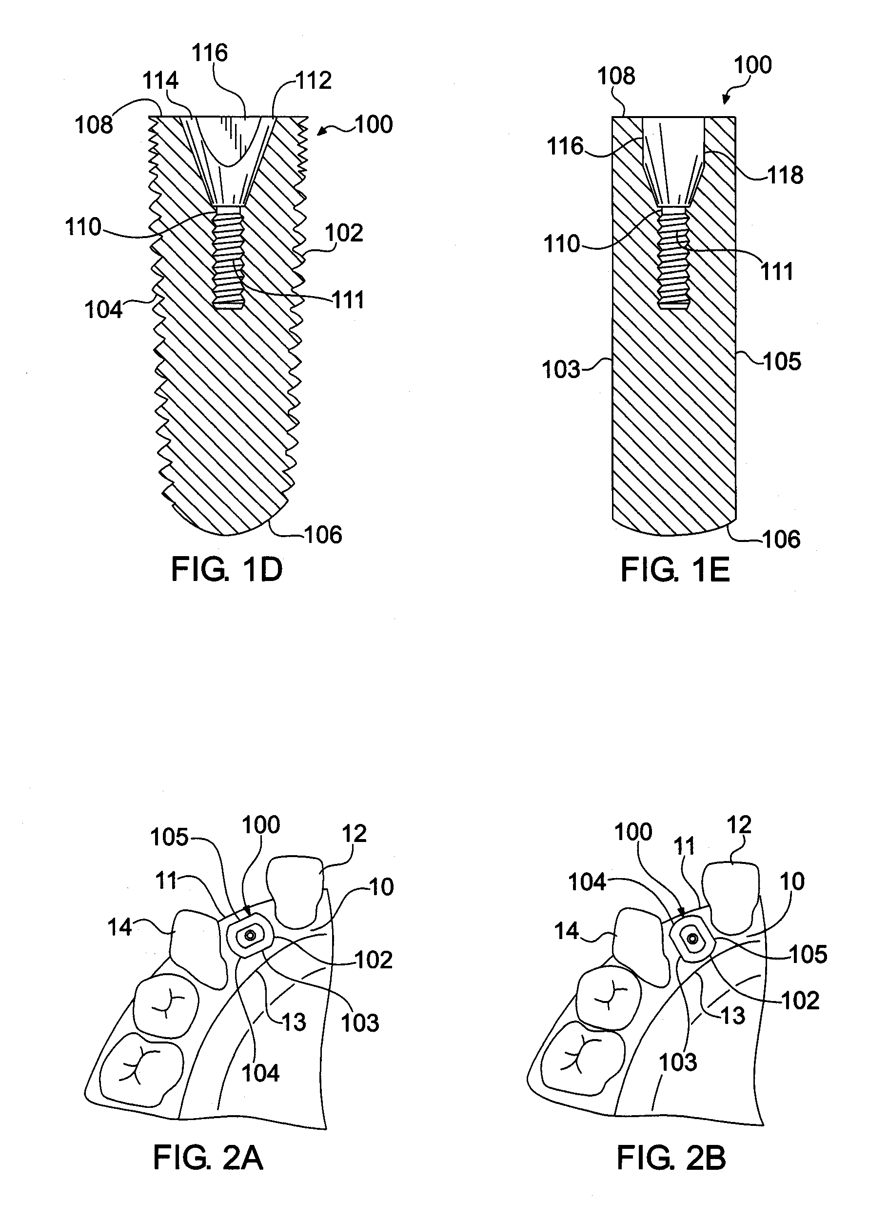 Endosseous dental implant and abutment for prevention of bone loss