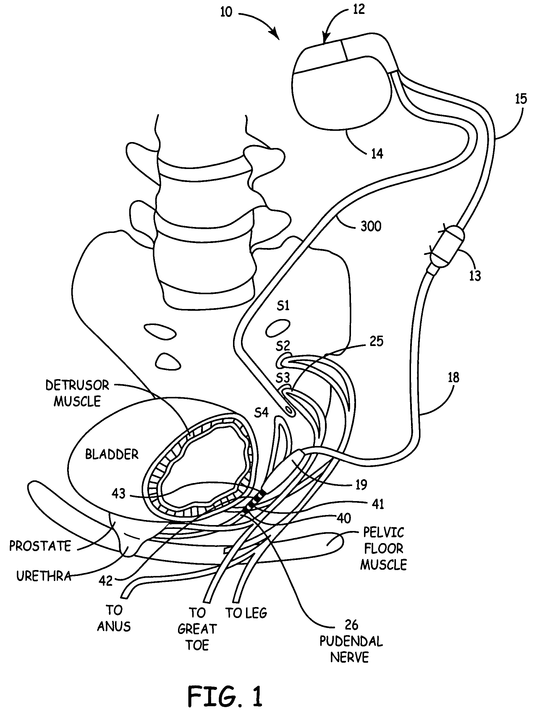Method, system and device for treating disorders of the pelvic floor by drug delivery to the pudendal and sacral nerves