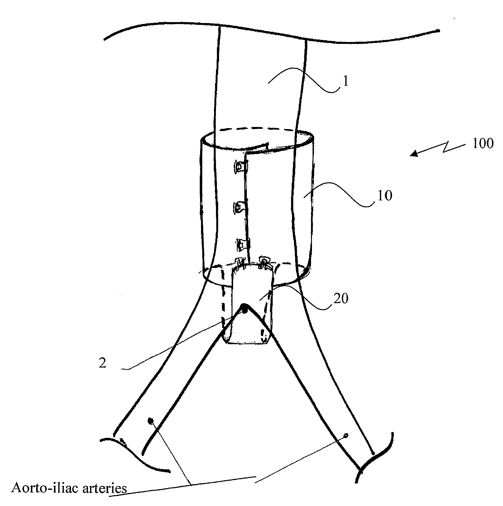 Extra-vascular wrapping for treating aneurysmatic aorta and methods thereof