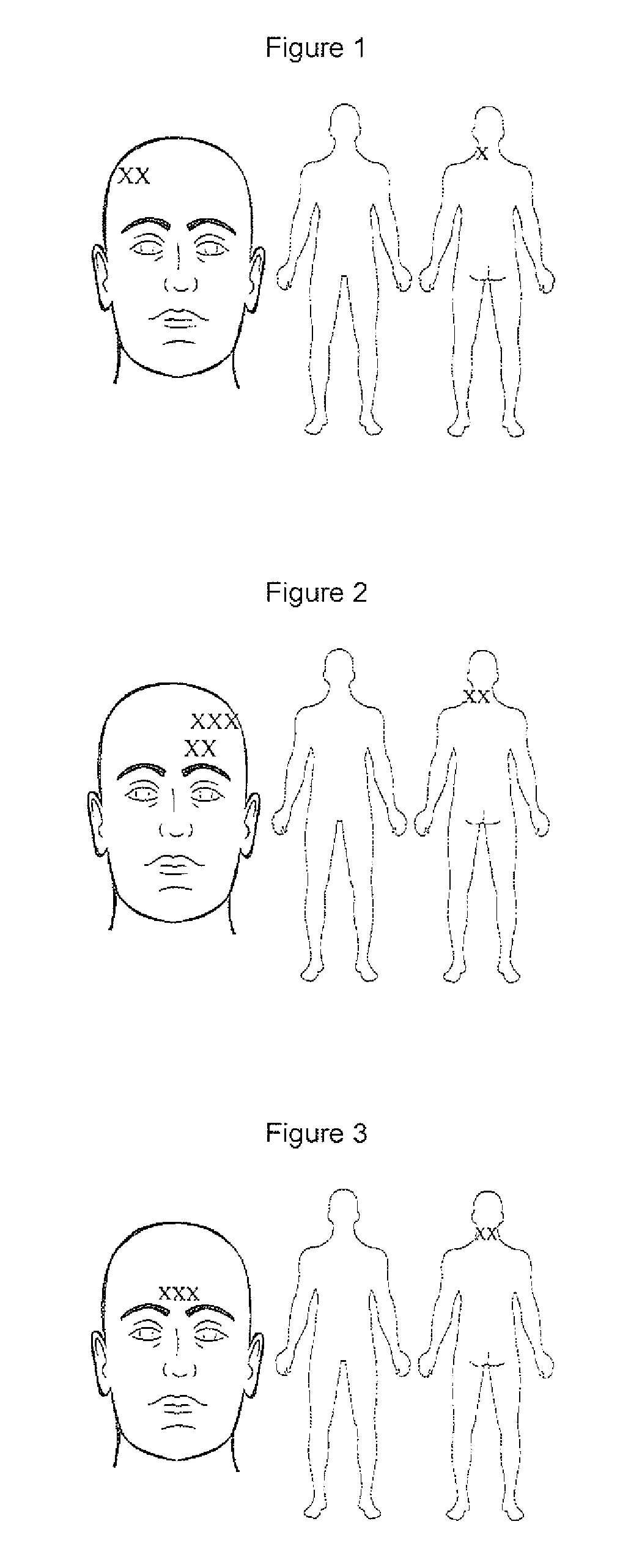 Compositions and methods for treating traumatic brain injury