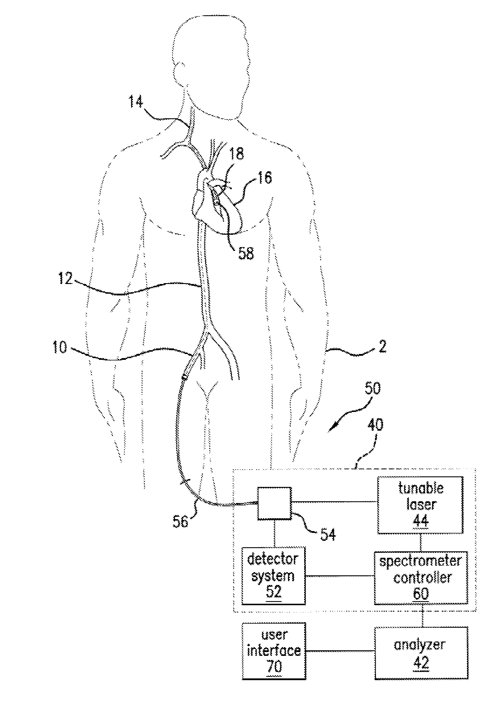 Method and system for intra luminal thrombus detection