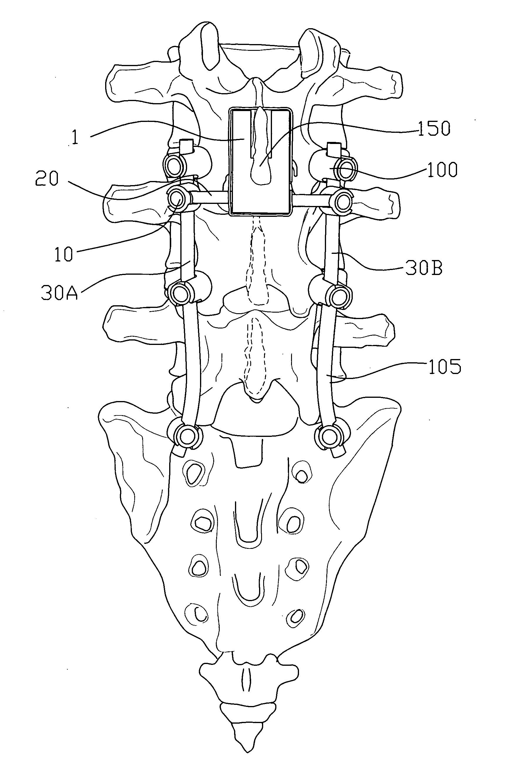 Spinal implant device, procedure and system