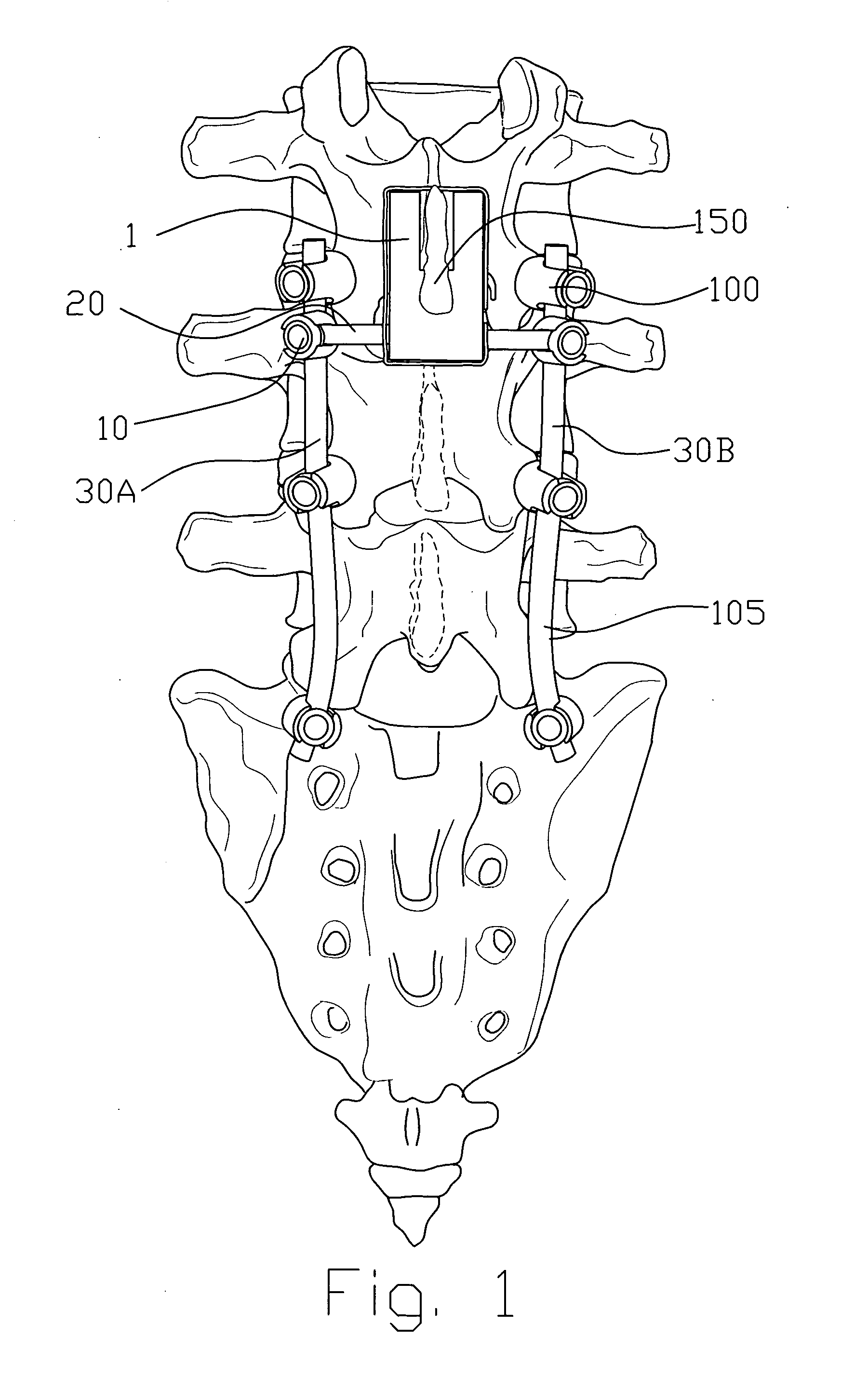 Spinal implant device, procedure and system