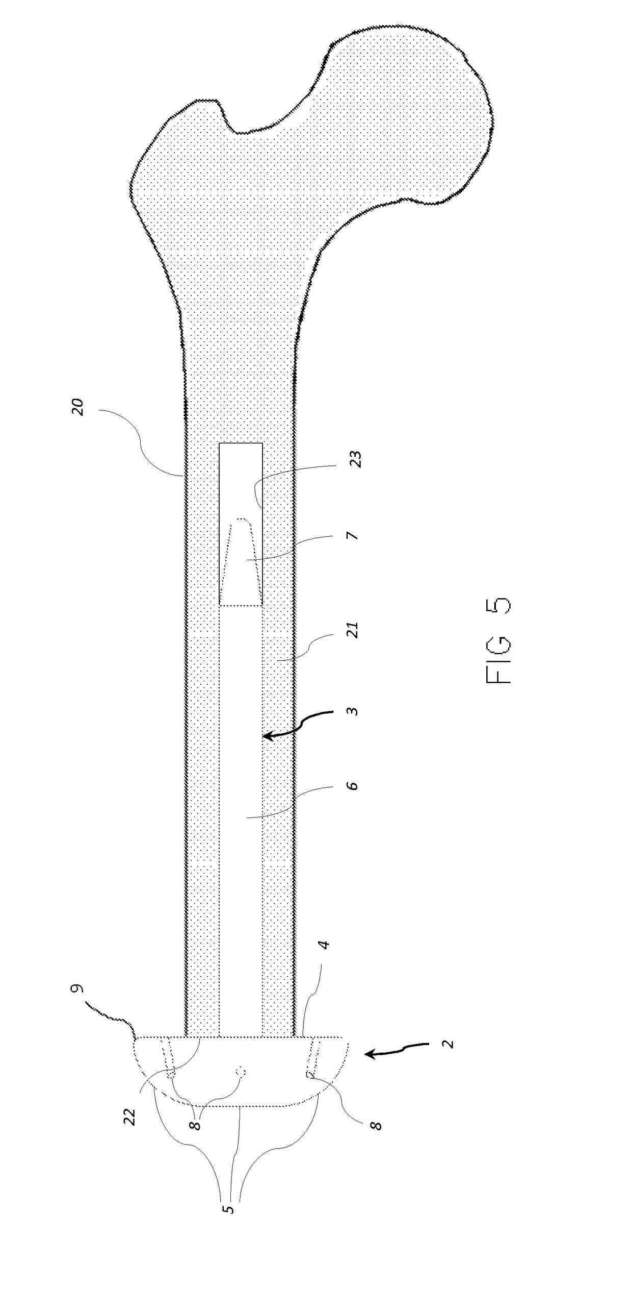 Implant for lower limb amputation