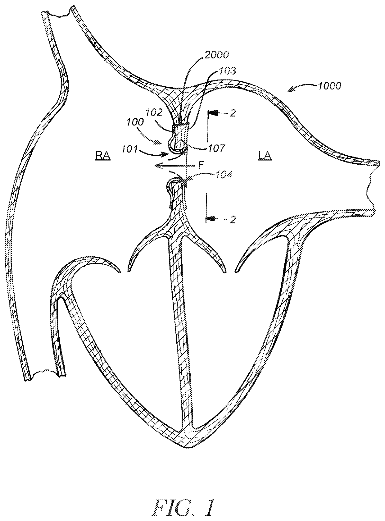 Intra-atrial implants made of non-braided material