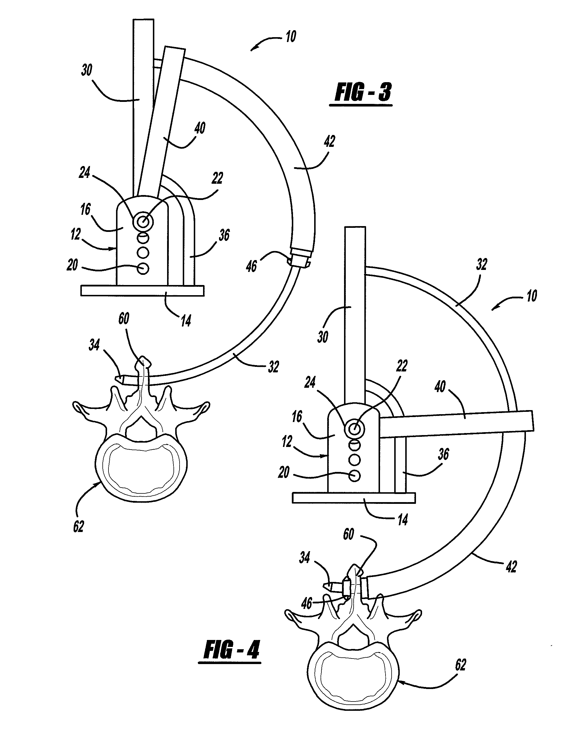 Interspinous Process Spacer Device