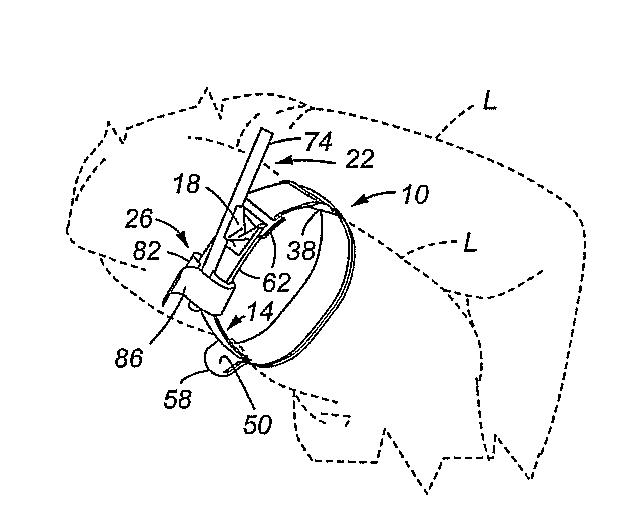 Tourniquet and method of use