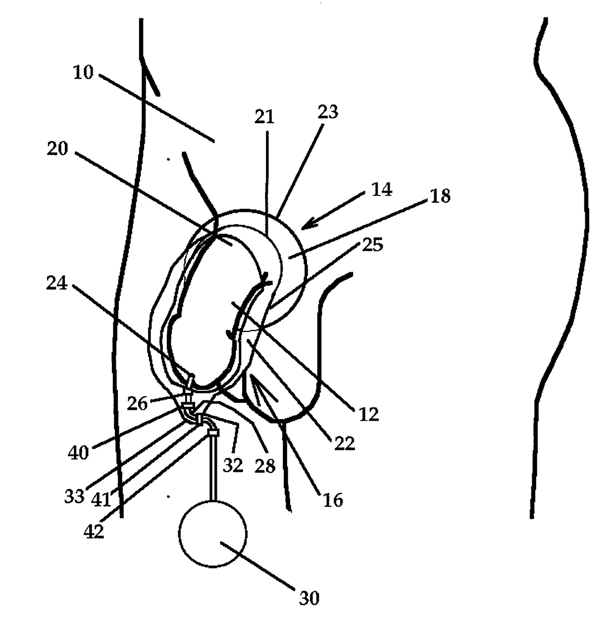 Male external catheter