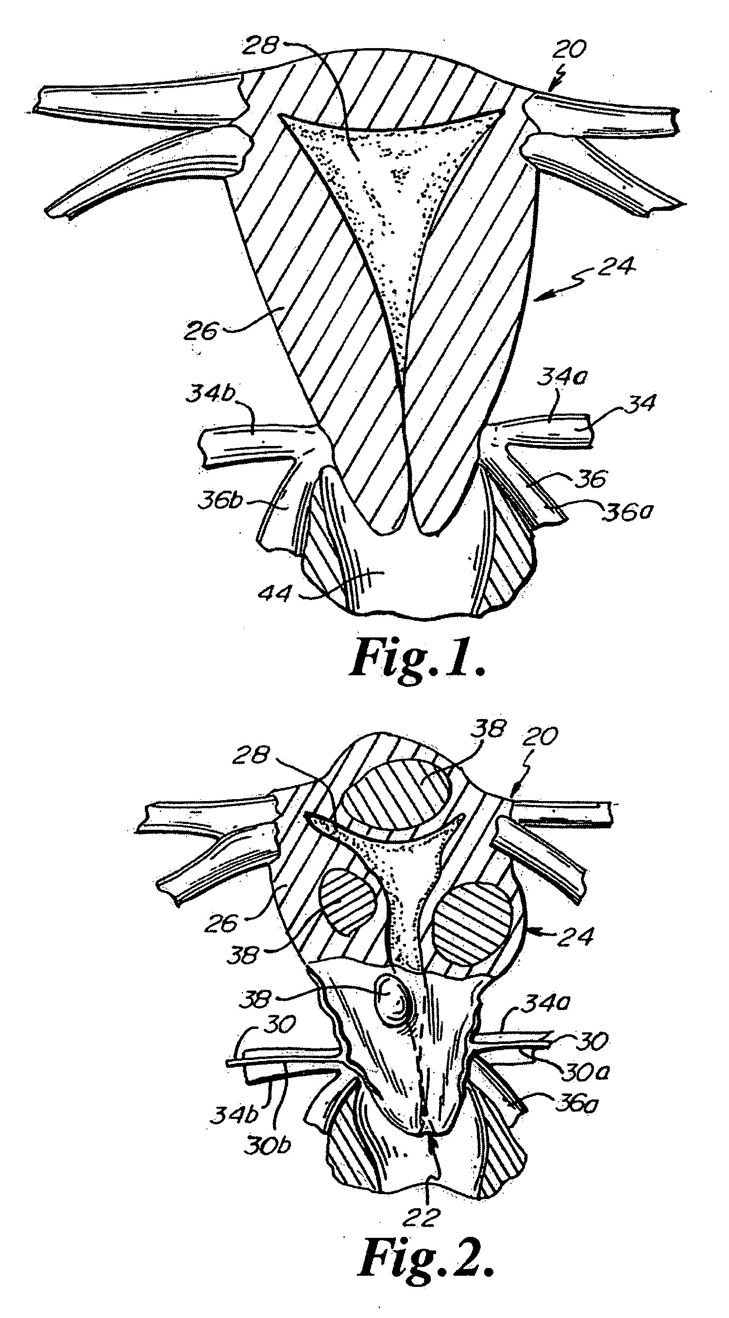 Devices and Methods for Ligating Uterine Arteries