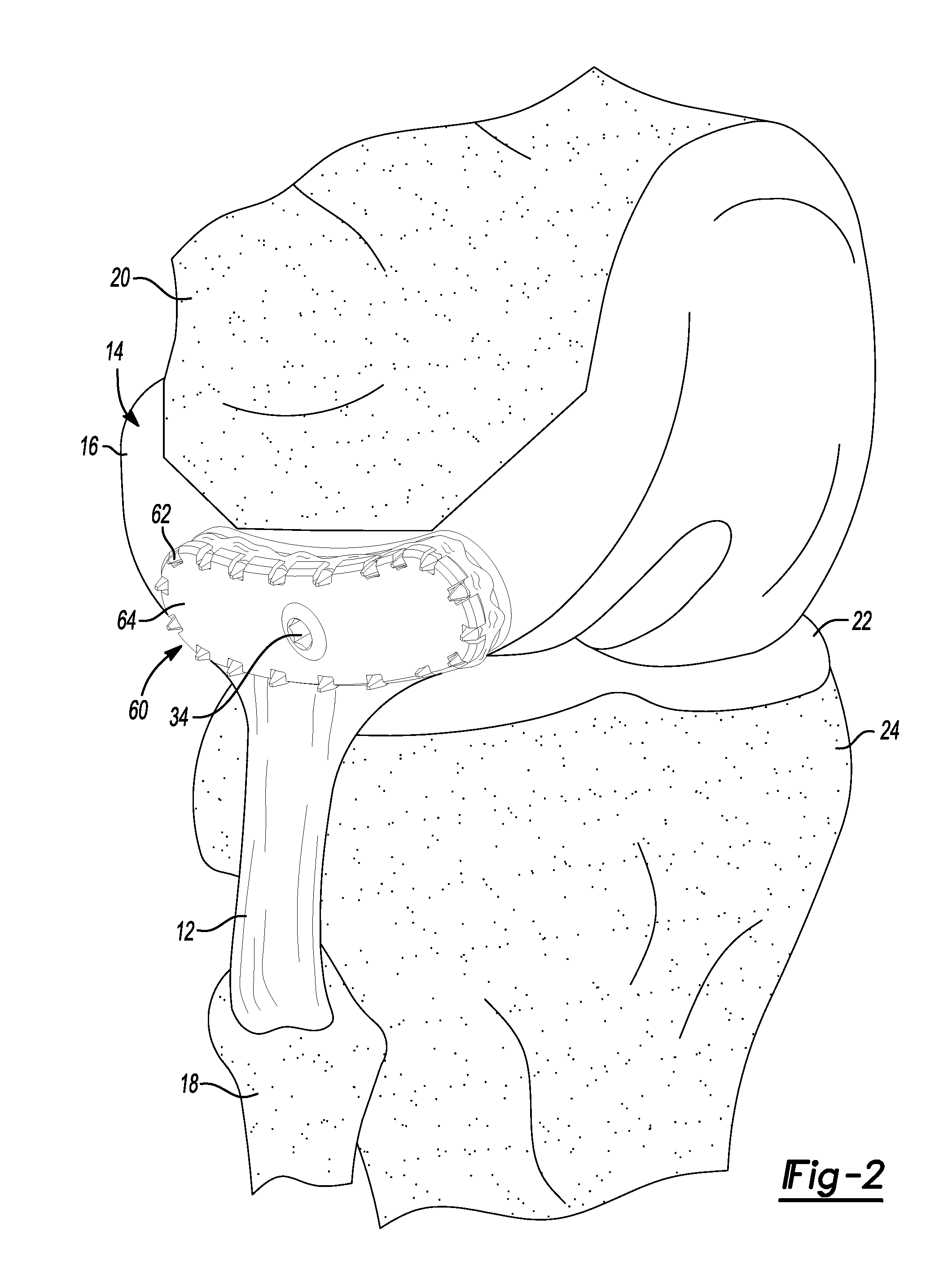 Method And Apparatus For Attaching Soft Tissue To Bone