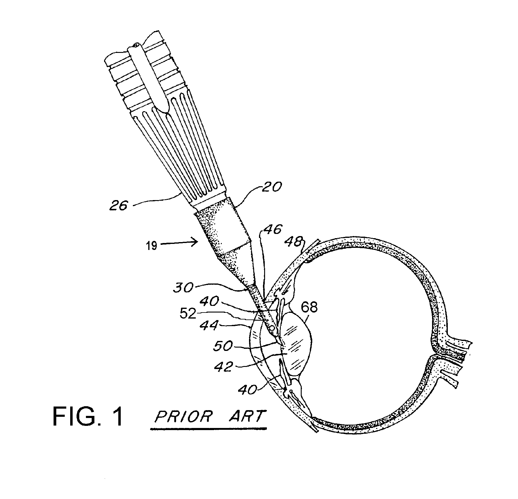 Phacoemulsification probe with tip shield