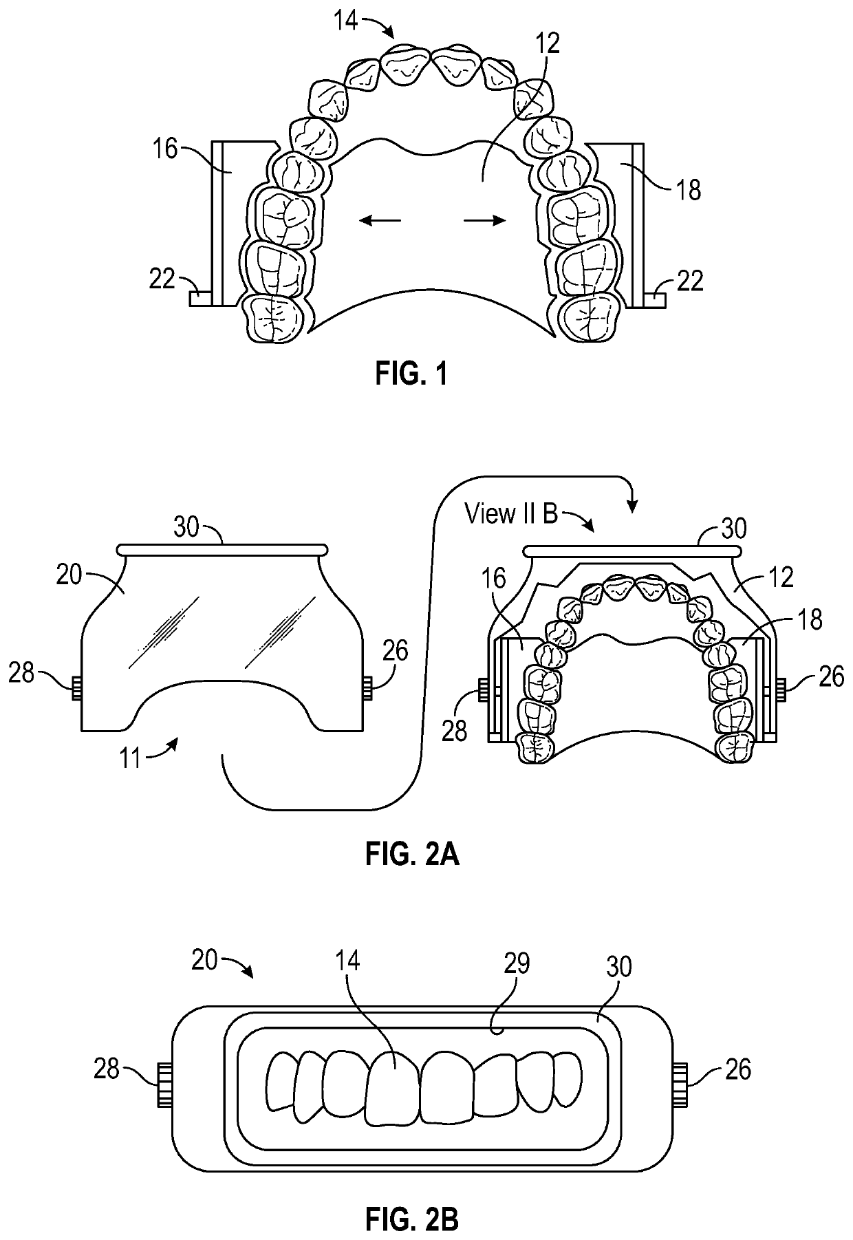 Apparatus for in situ restoration of unconstrained dental structure
