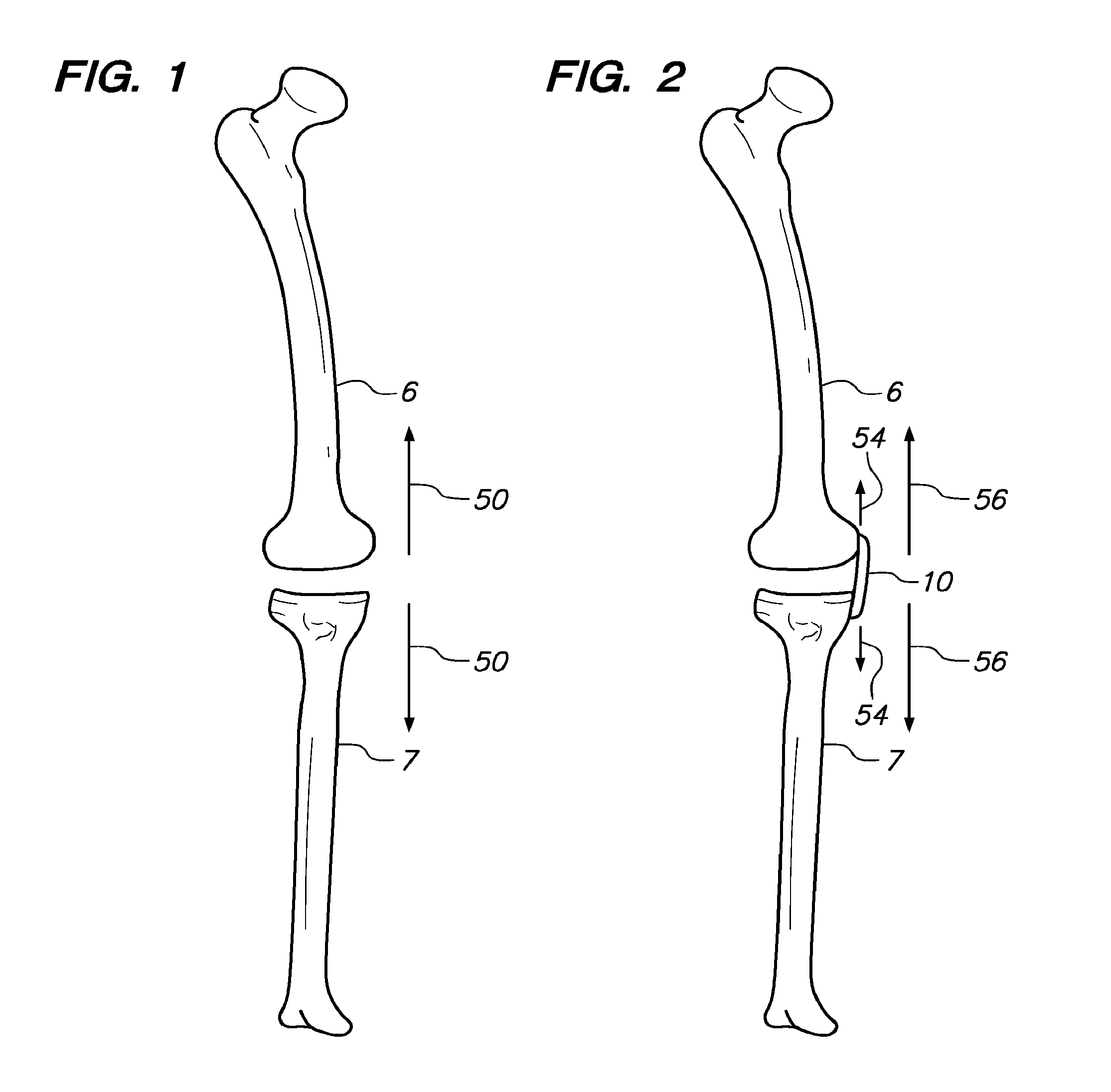 Extra-articular implantable mechanical energy absorbing assemblies having two deflecting members and methods