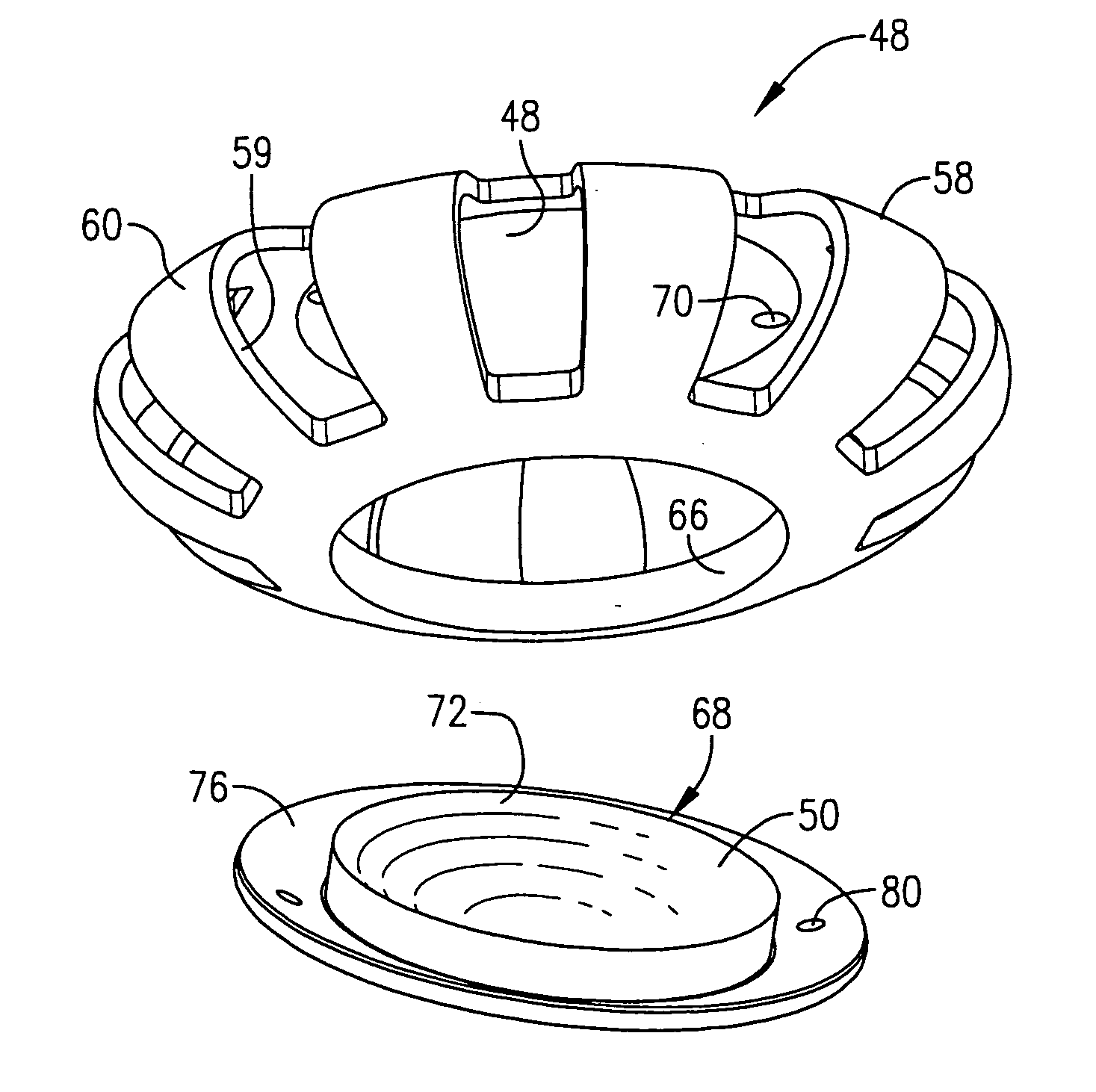 Telescopic intraocular lens implant for treating age-related macular degeneration