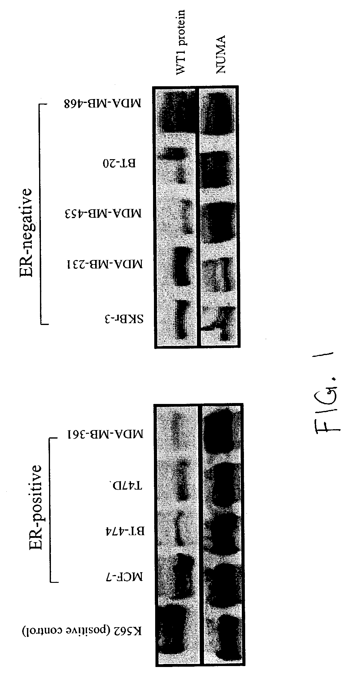 WT1 antisense oligos for the inhibition of breast cancer