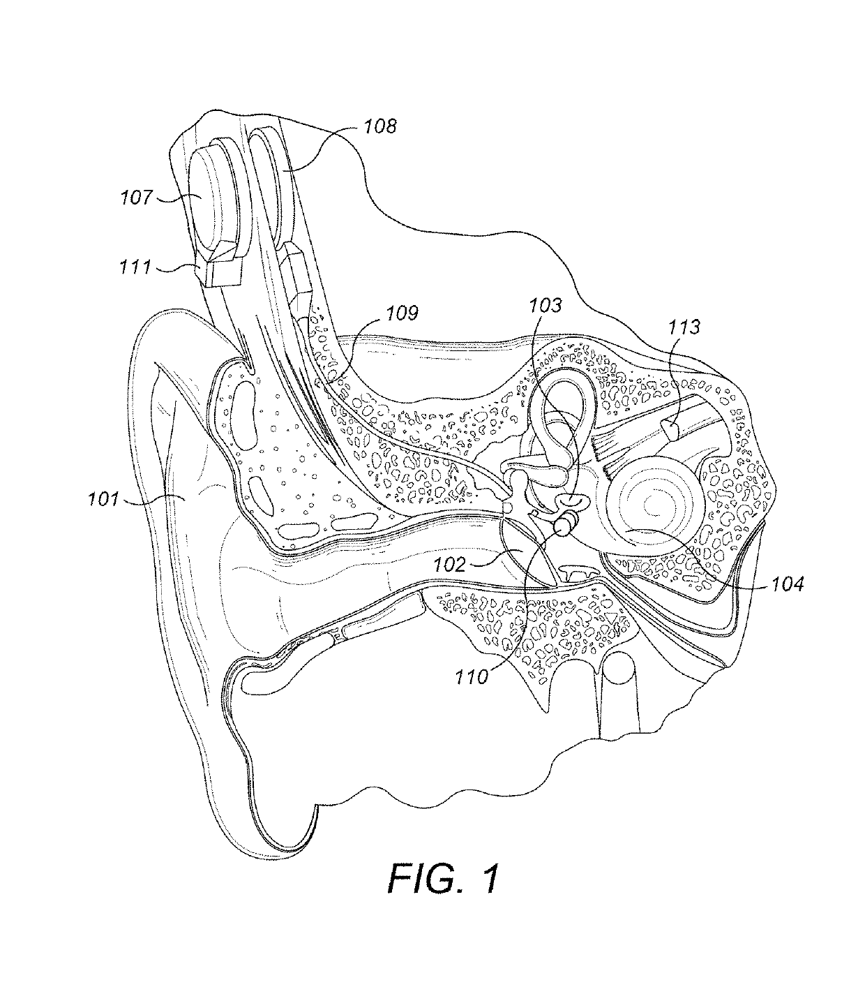 Pre-load feedback of a middle-ear coupler