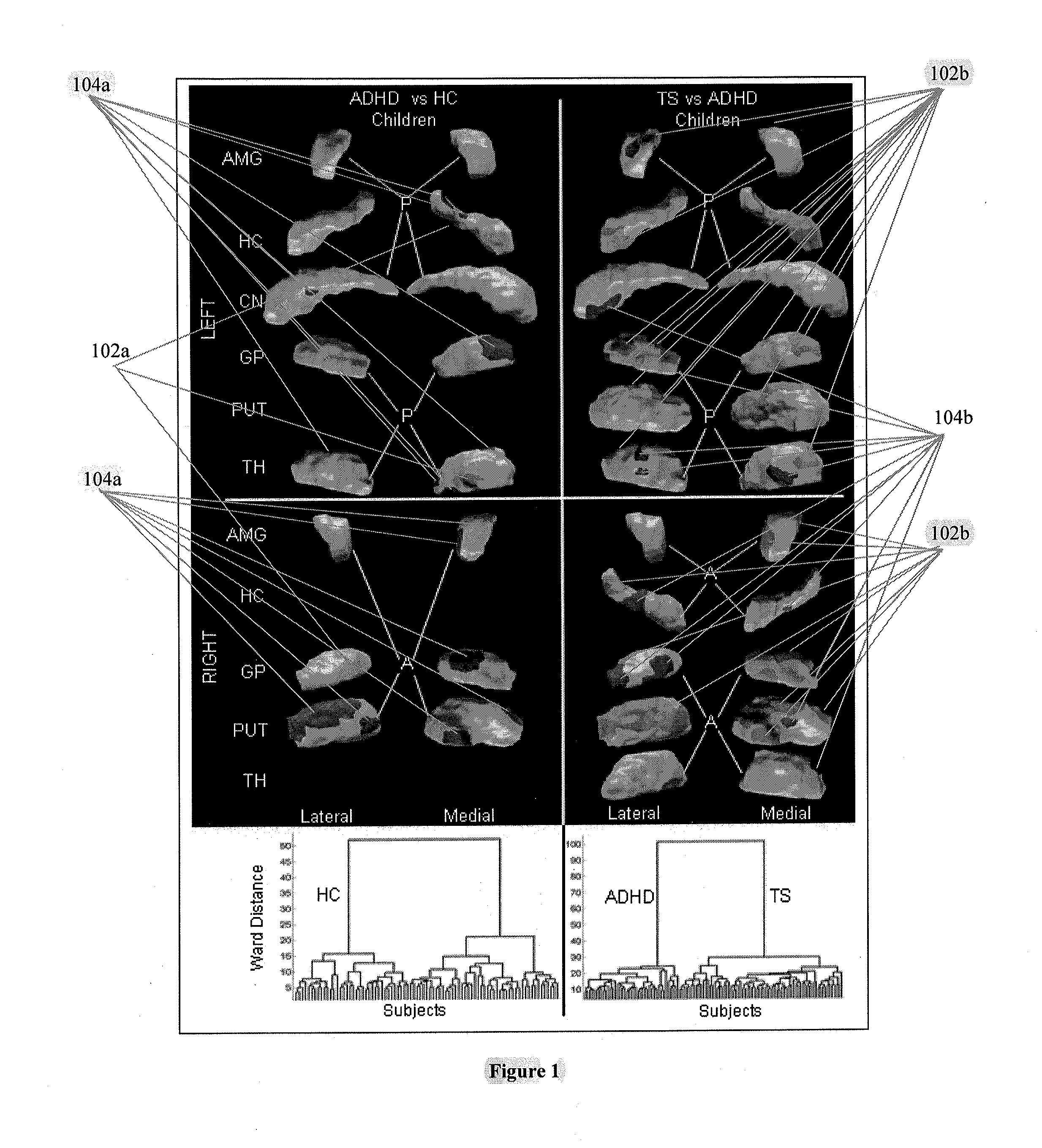 Apparatus, method and computer-accessible medium for diagnosing and subtyping psychiatric diseases