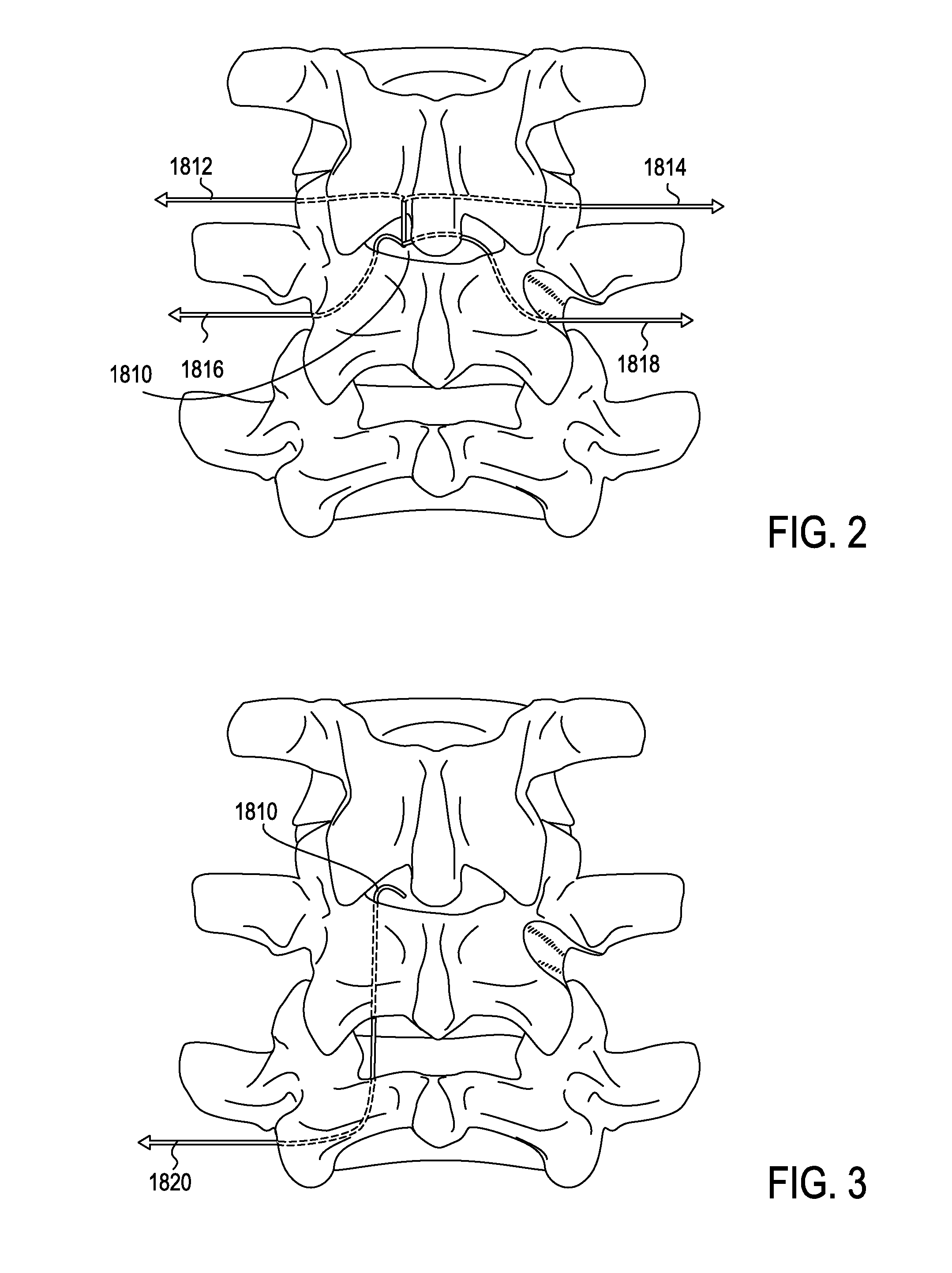 Devices and methods for treating tissue