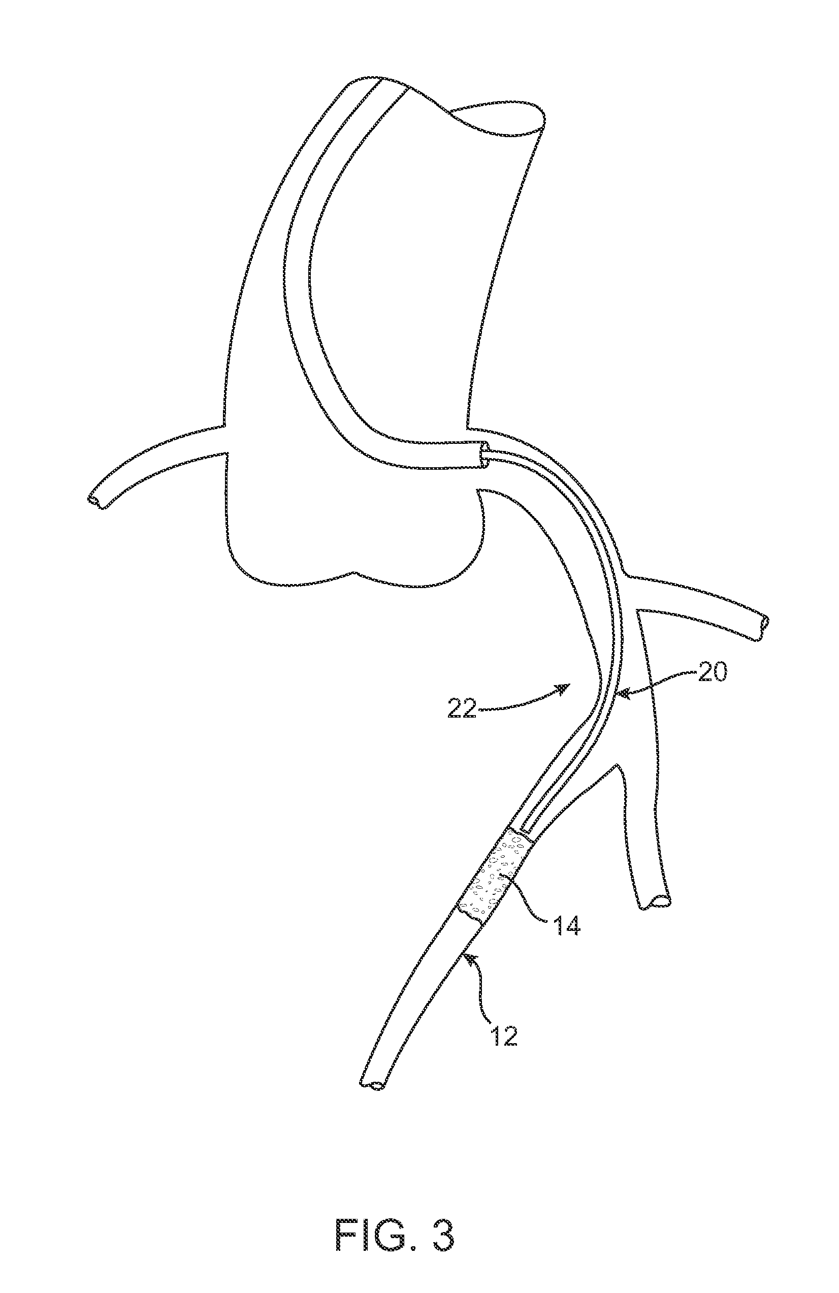Drug-Eluting Device for Treatment of Chronic Total Occlusions