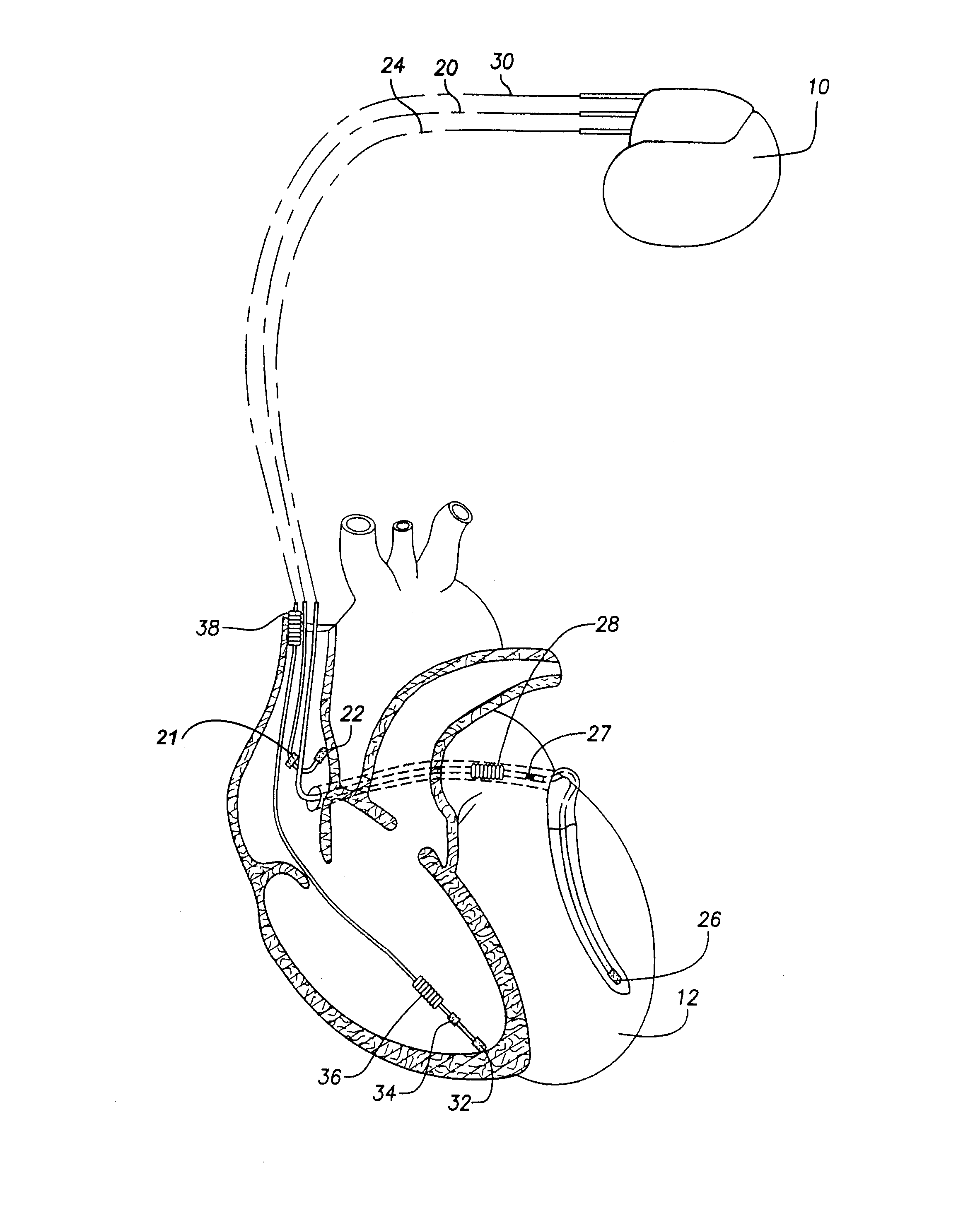 Systems and methods for preventing, detecting, and terminating pacemaker mediated tachycardia in biventricular implantable cardiac stimulation systems