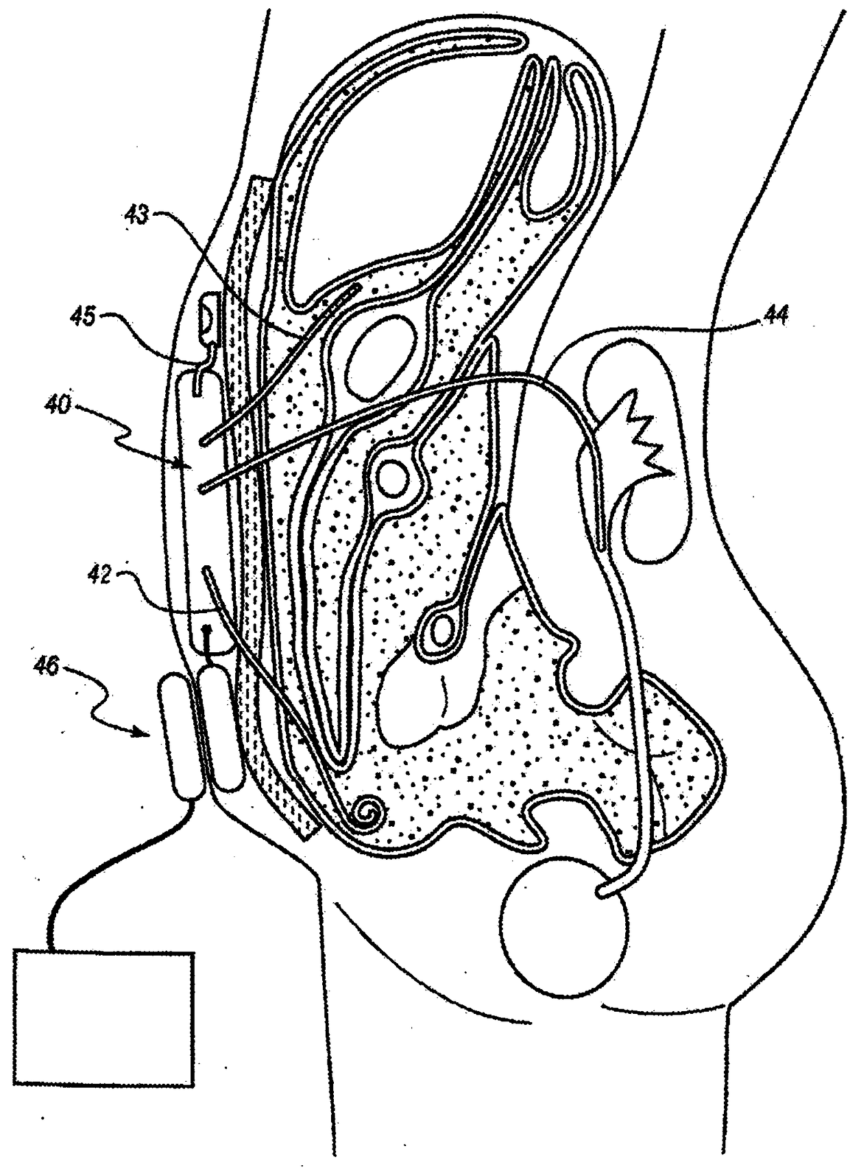 Peritoneal dialysis systems and methods