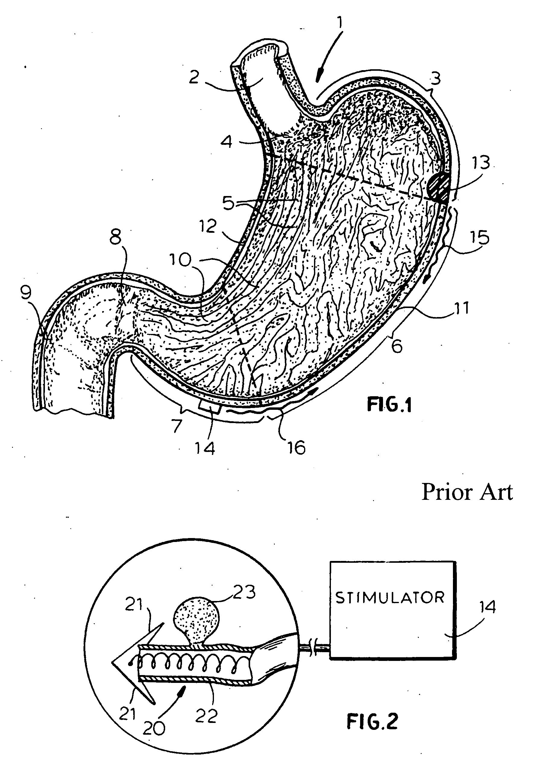 Method and device for treating obesity by suppressing appetite and hunger using vibration