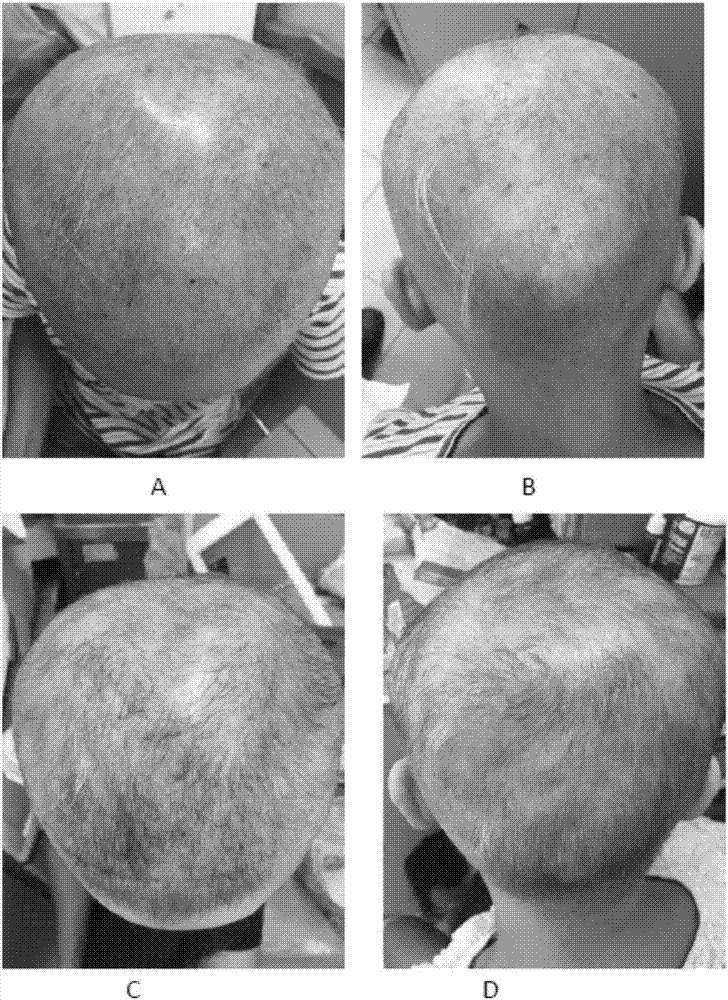 Externally applied medicament for treating and/or preventing male-pattern alopecia