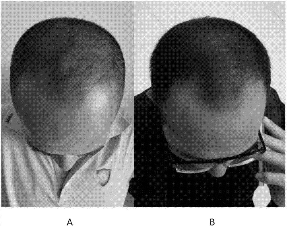 Externally applied medicament for treating and/or preventing male-pattern alopecia