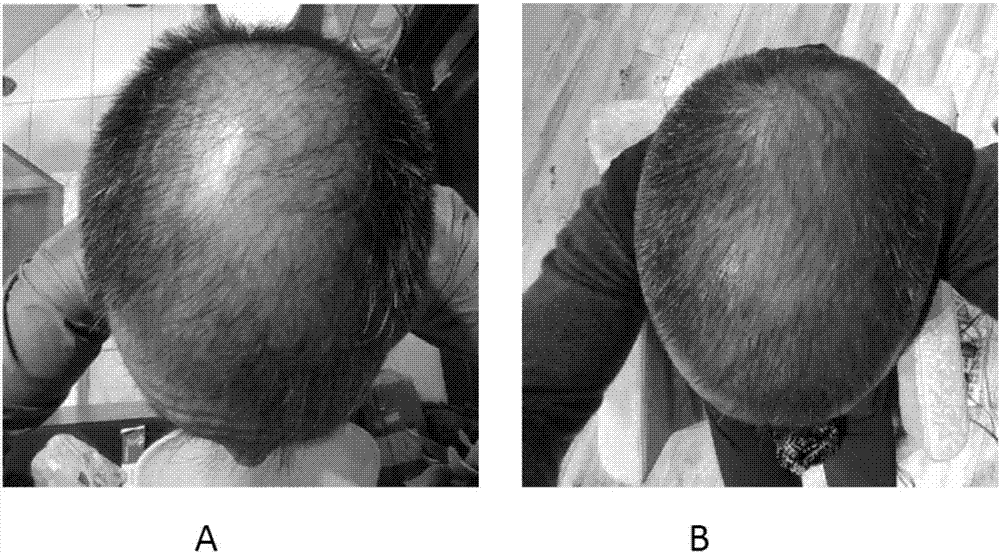 Externally applied medicament for treating and/or preventing male-pattern alopecia