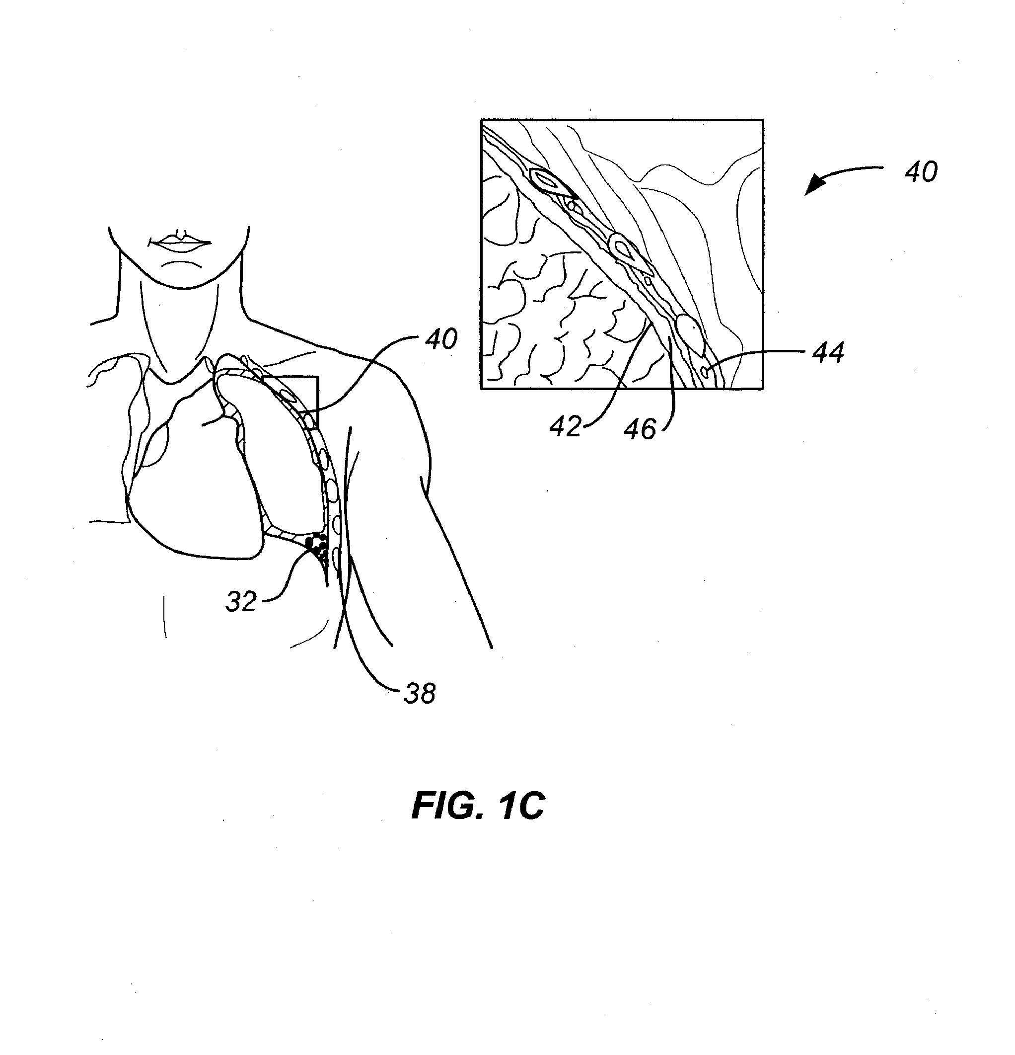 Minimally invasive lung volume reduction device and method