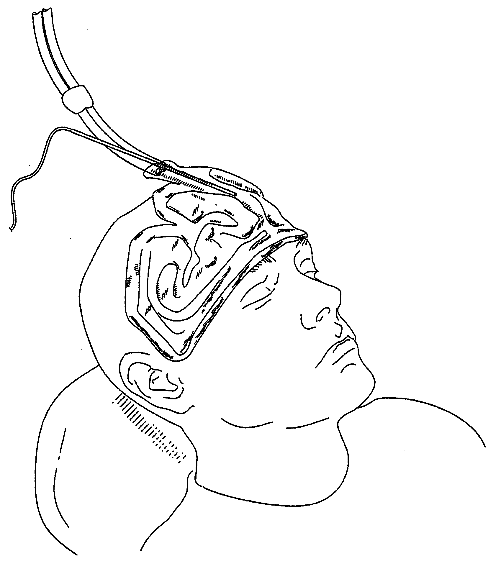 Methods, devices and systems for treating insomnia by inducing frontal cerebral hypothermia