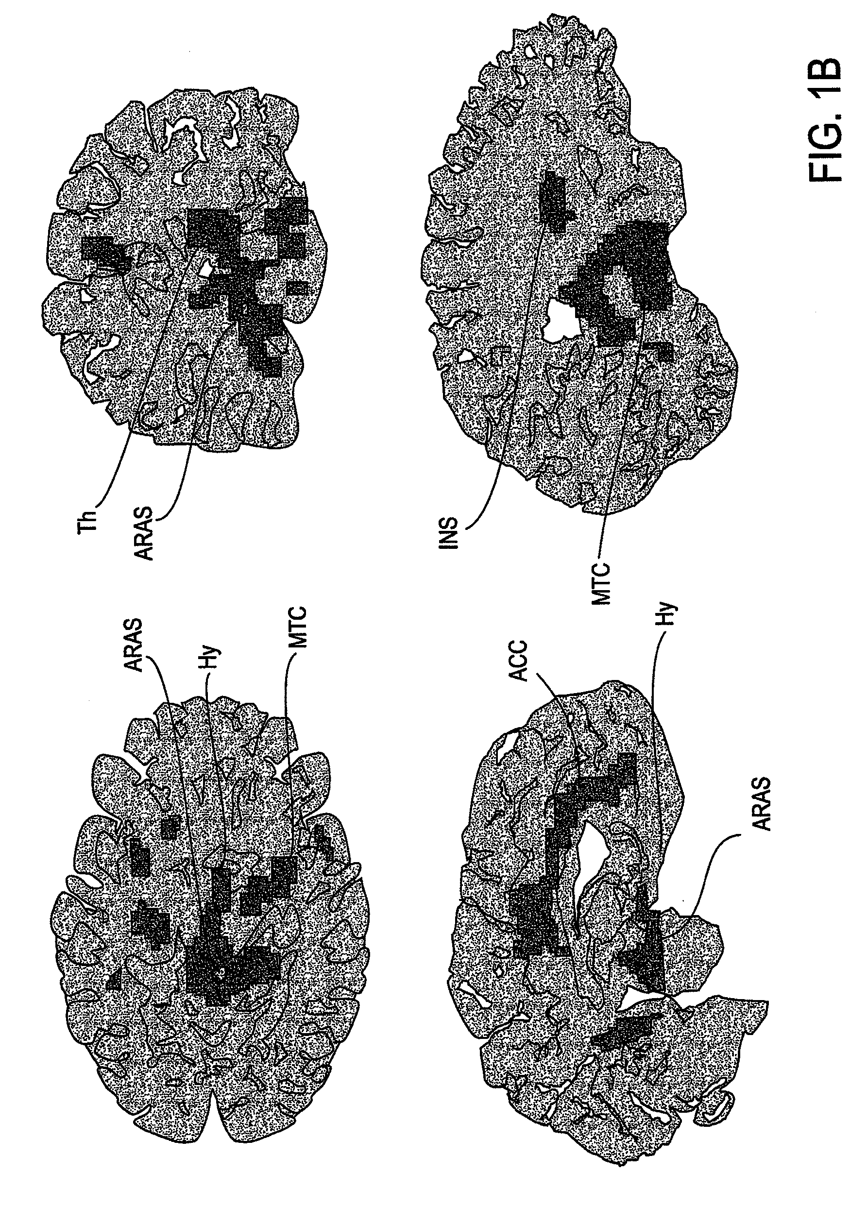 Methods, devices and systems for treating insomnia by inducing frontal cerebral hypothermia