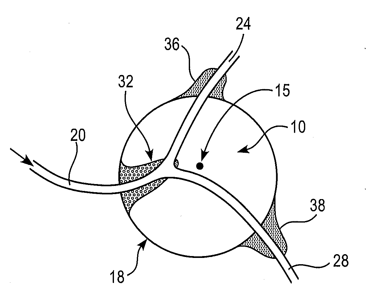 Local embolization using thermosensitive polymers