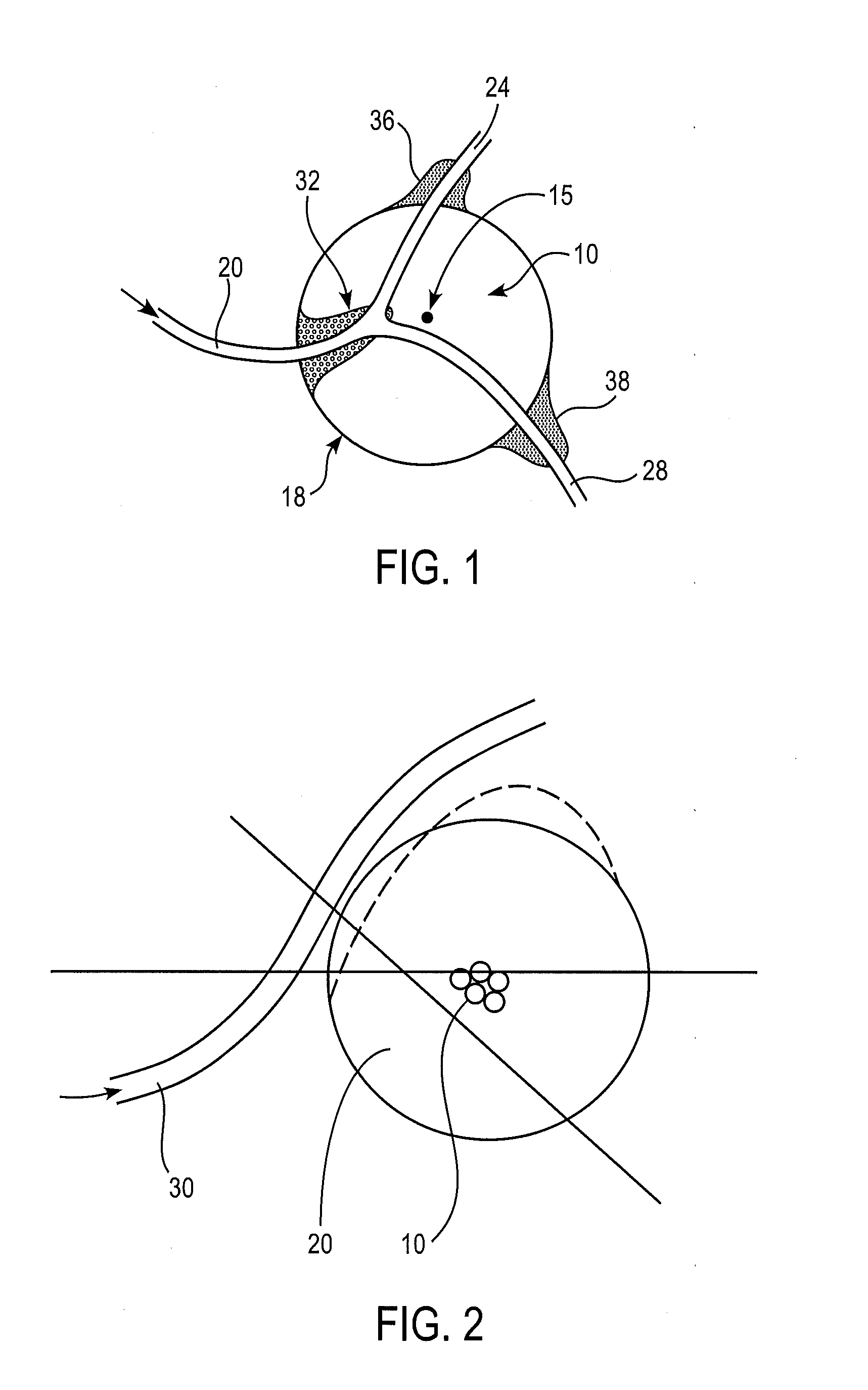 Local embolization using thermosensitive polymers