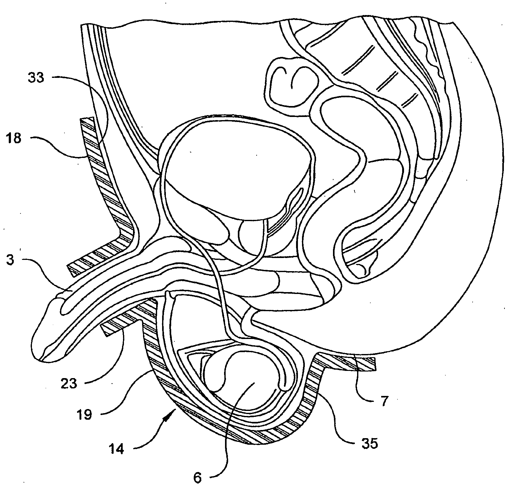 Therapeutic device for thermally assisted urinary function
