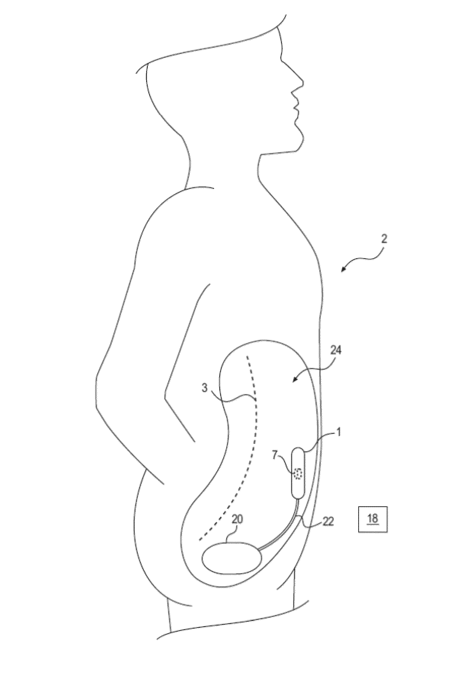 Method and device to treat kidney disease